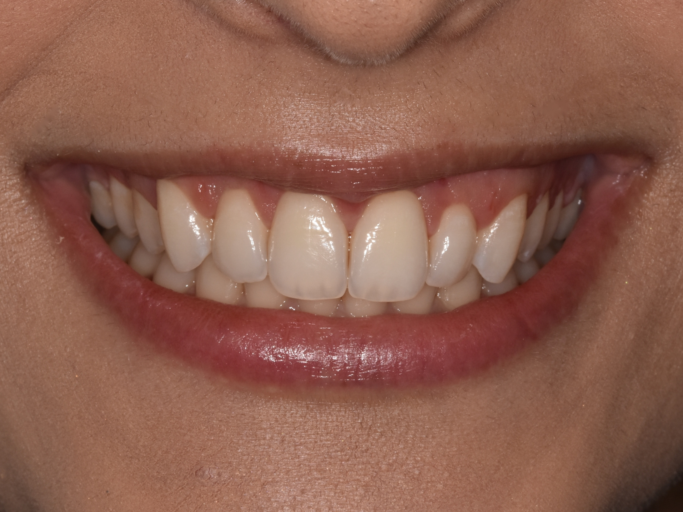Gum contouring, after treatment, front view of smile