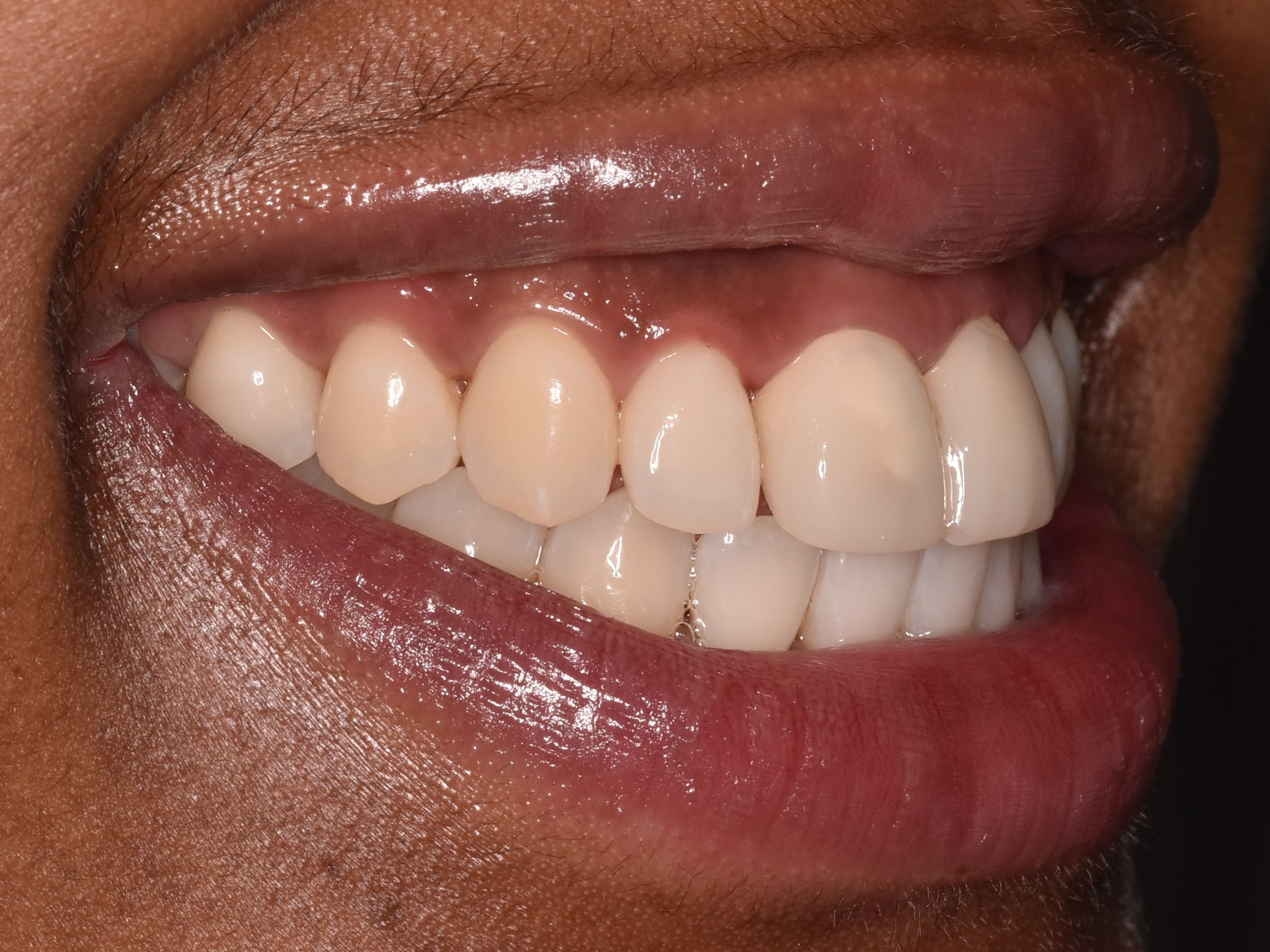 Gum contouring and replacement of 2 dental crowns, after treatment, left side view of smile