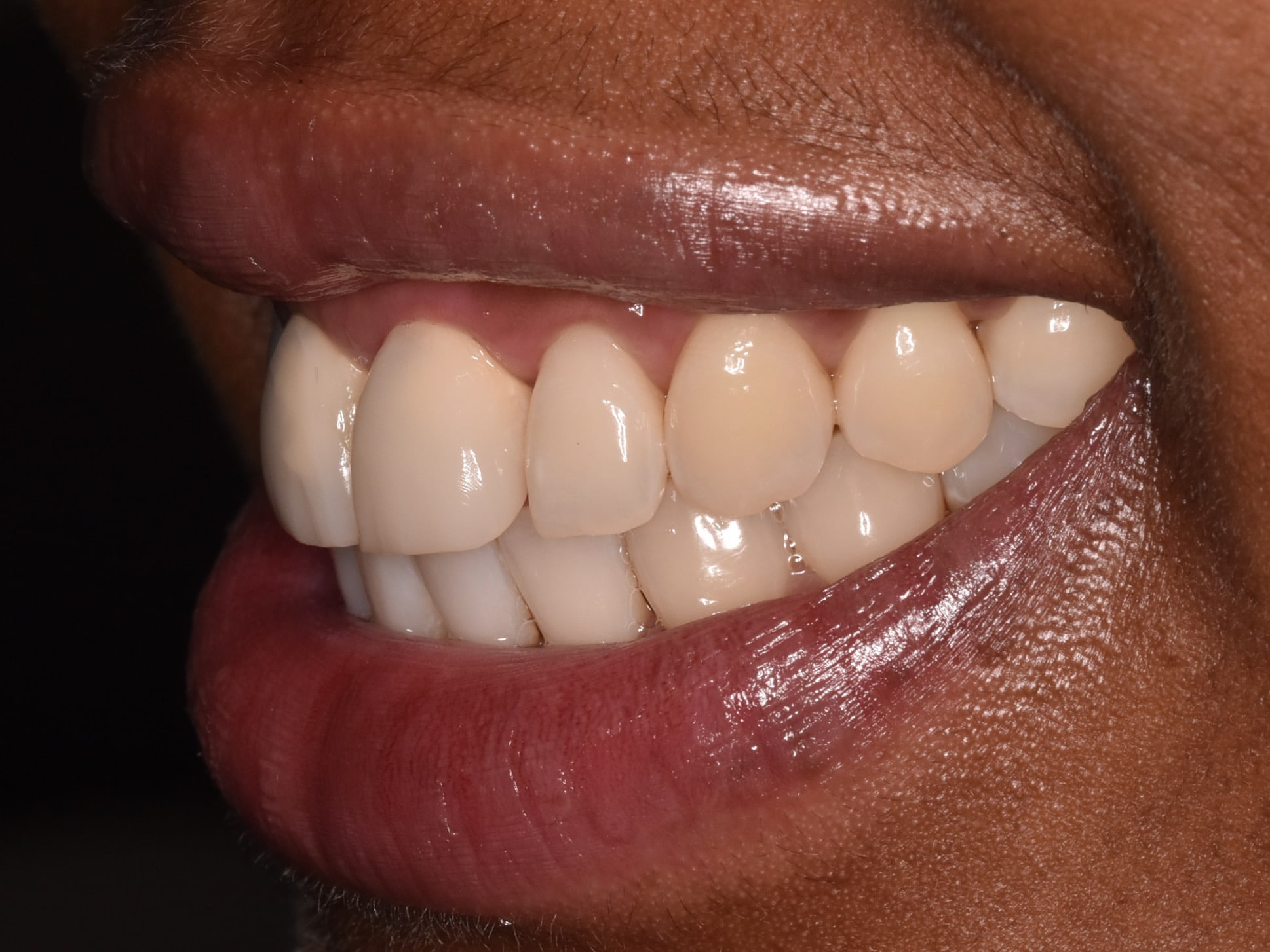 Gum contouring and replacement of 2 dental crowns, after treatment, right side view of smile