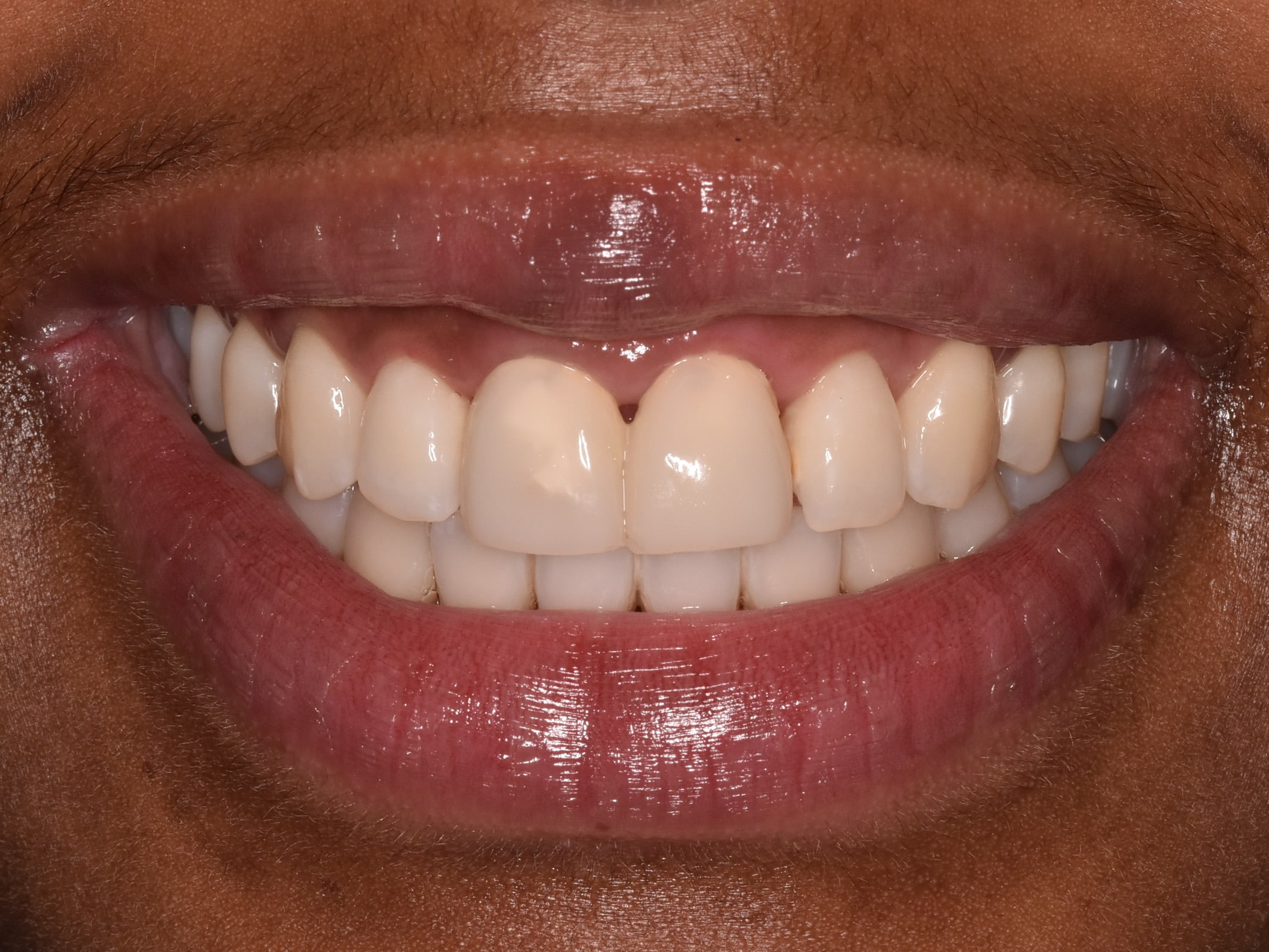 Gum contouring and replacement of 2 dental crowns, after treatment, front view of smile