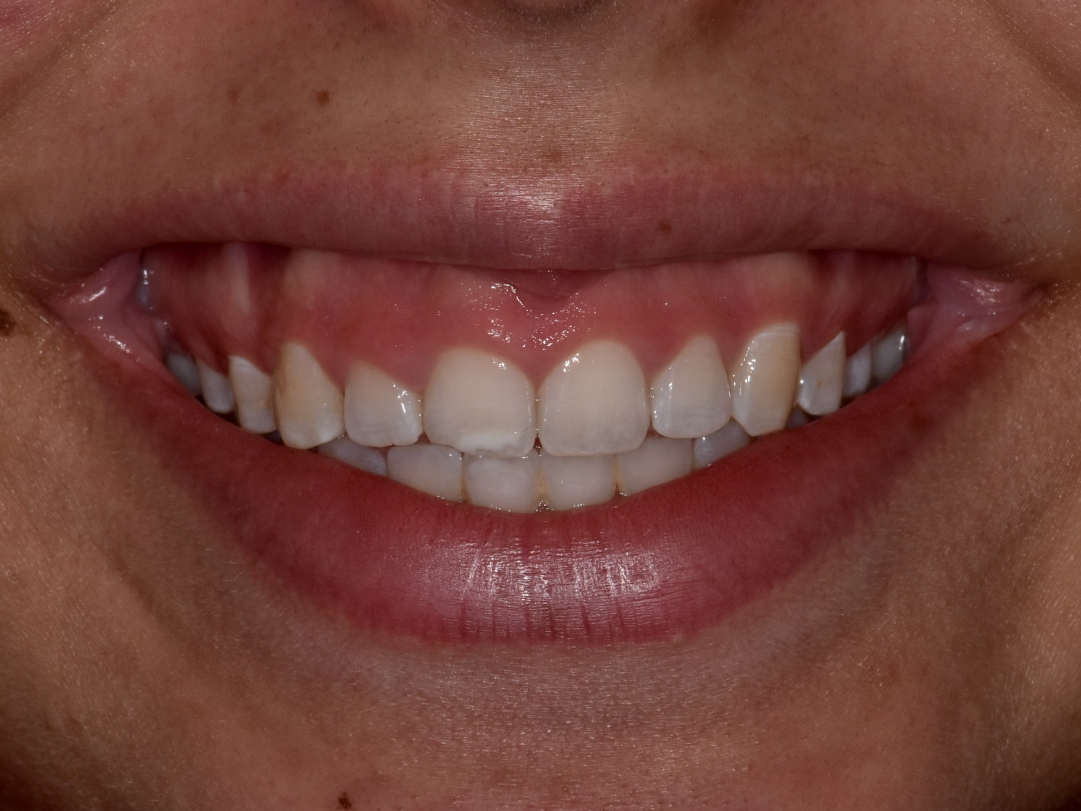 Gum contouring and composite bonding, before treatment, front view of smile