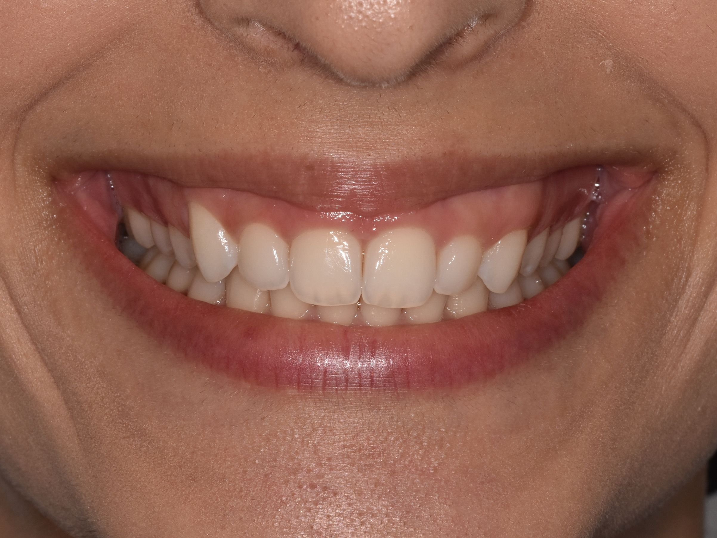 Gum contouring, before treatment, front view of smile