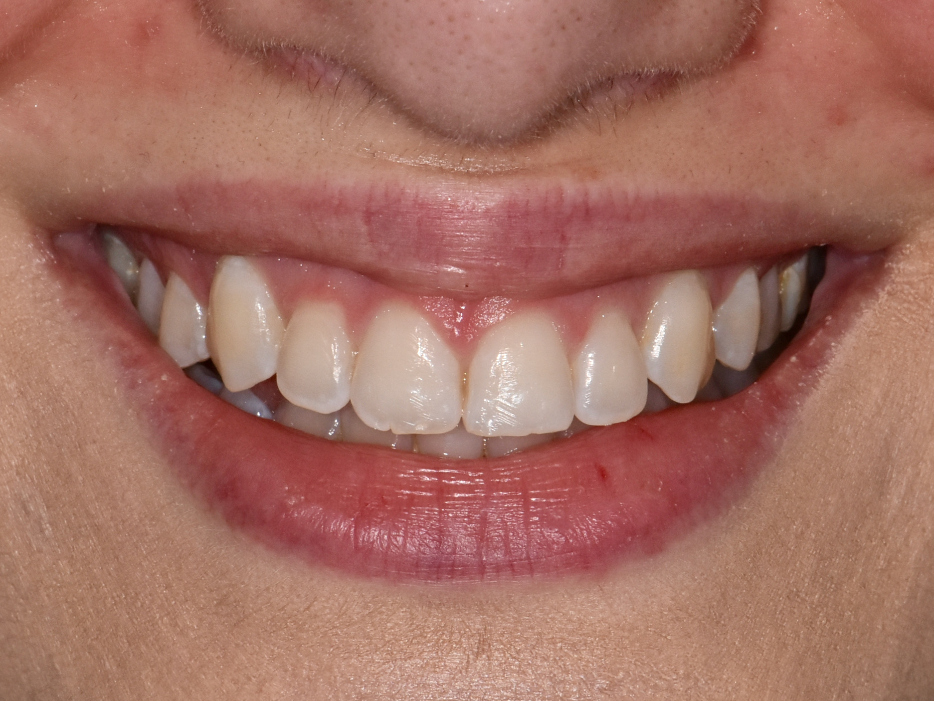 Gum contouring and composite bonding on 10 teeth, before treatment, front view of smile