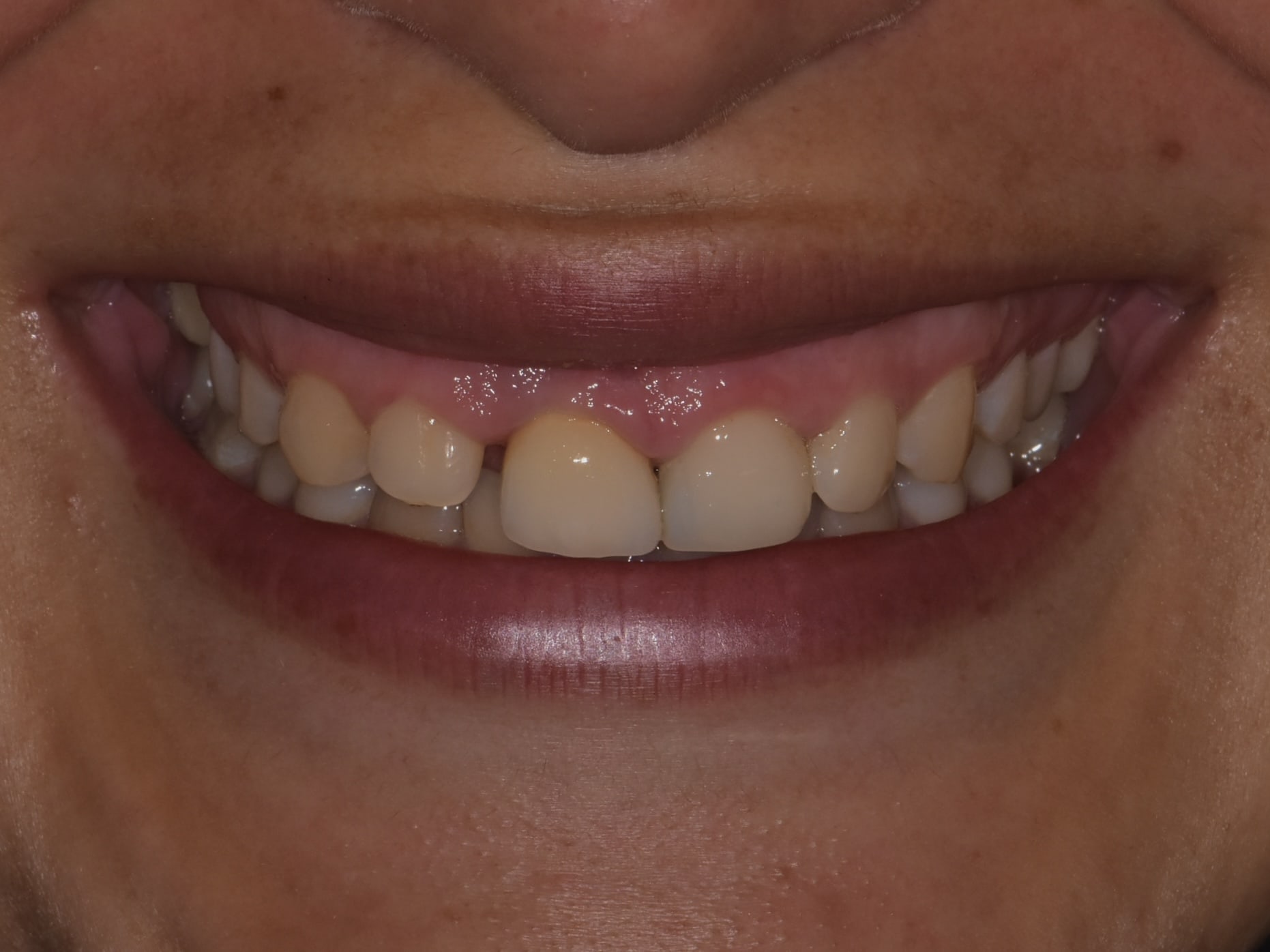 Gum contouring, 1 implant and 1 dental crown, before treatment, front view of smile