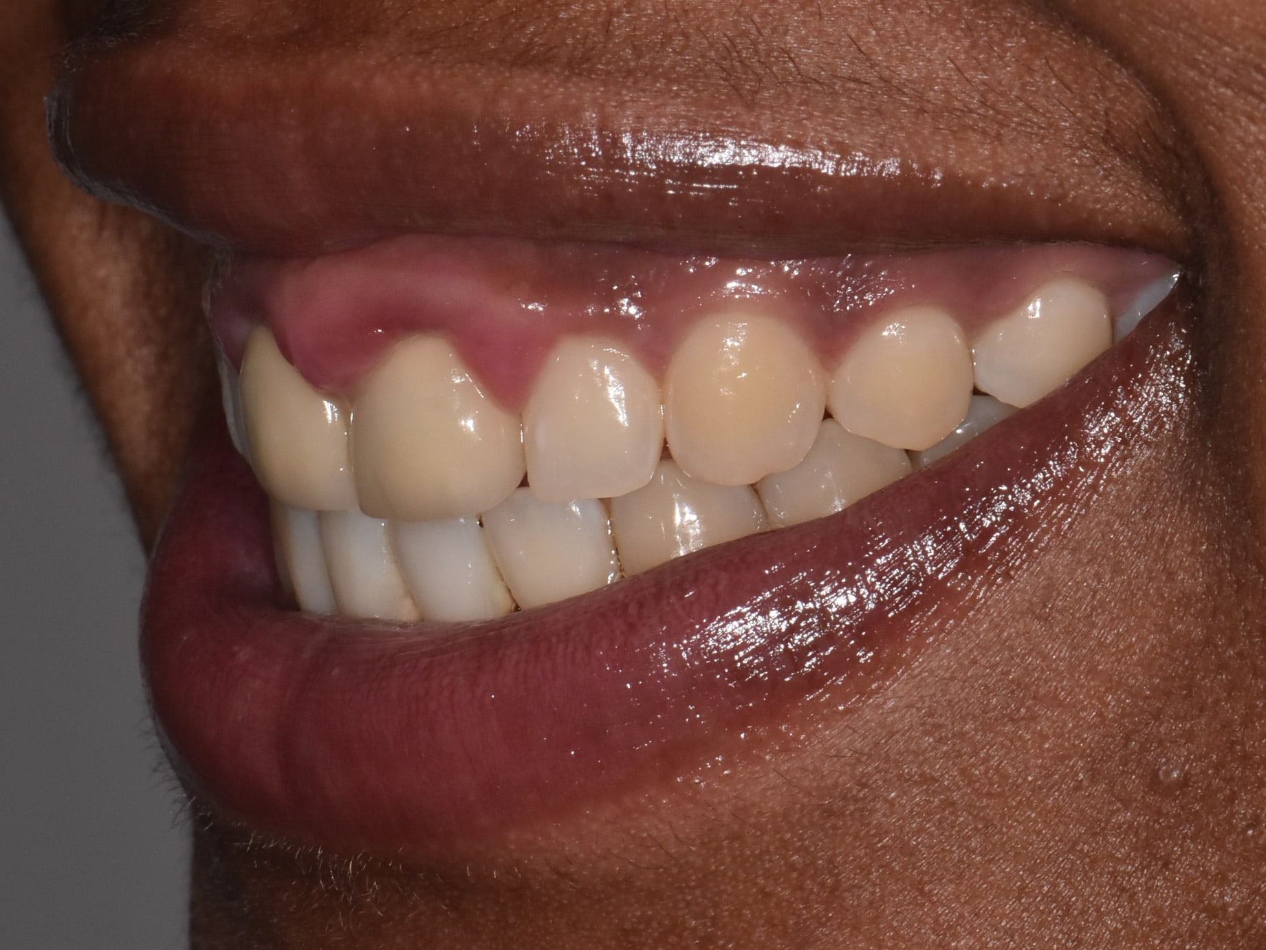 Gum contouring and replacement of 2 dental crowns, before treatment, right side view of smile