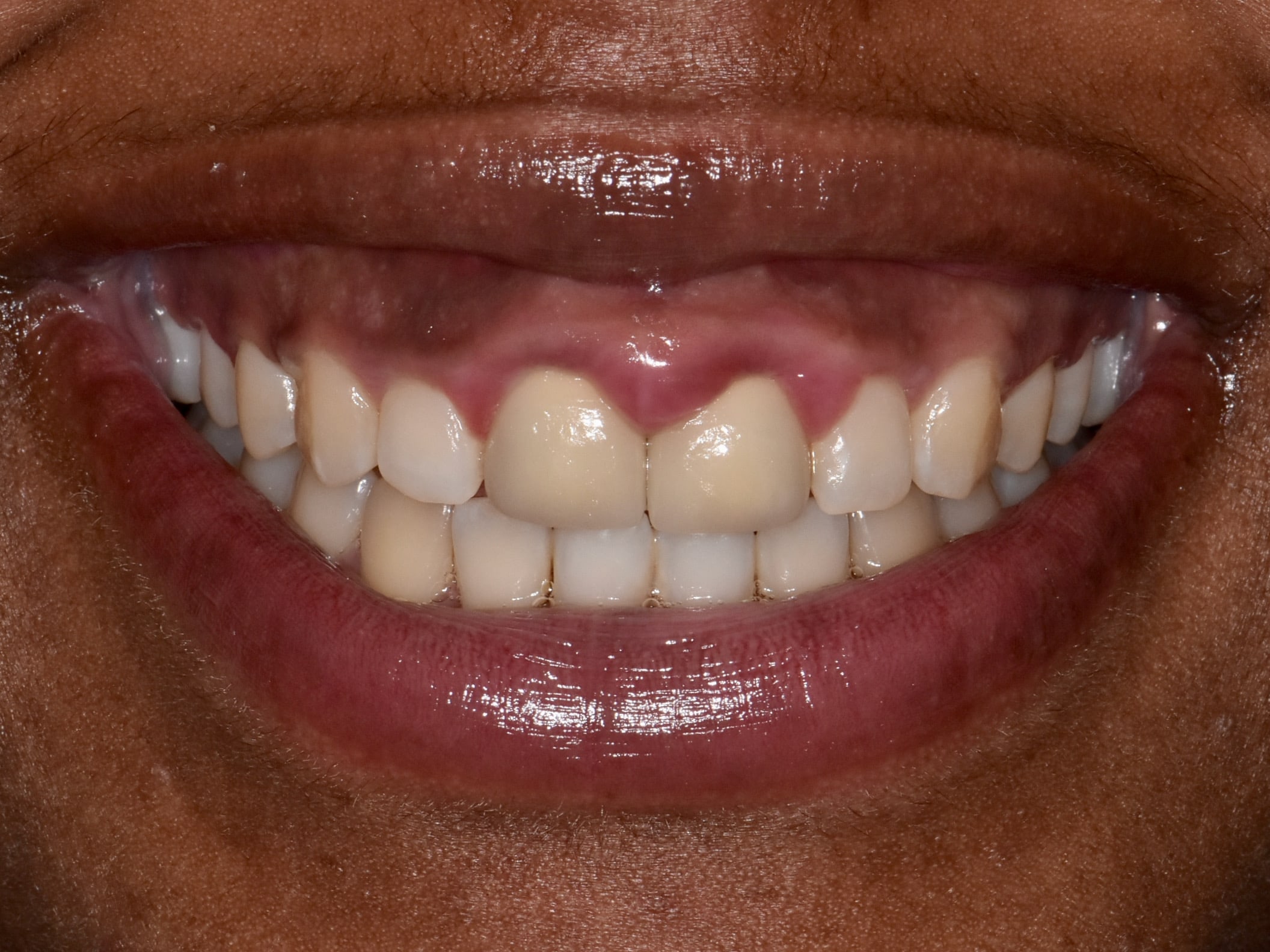Gum contouring and replacement of 2 dental crowns, before treatment, front view of smile