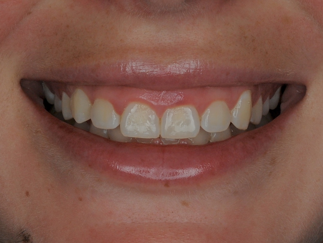 Gum contouring, front view of smile