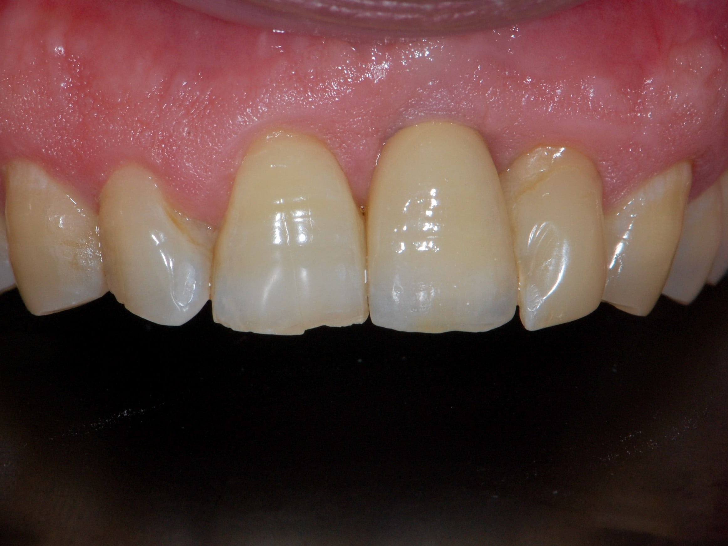 Single implant, after treatment, close-up of teeth and gums