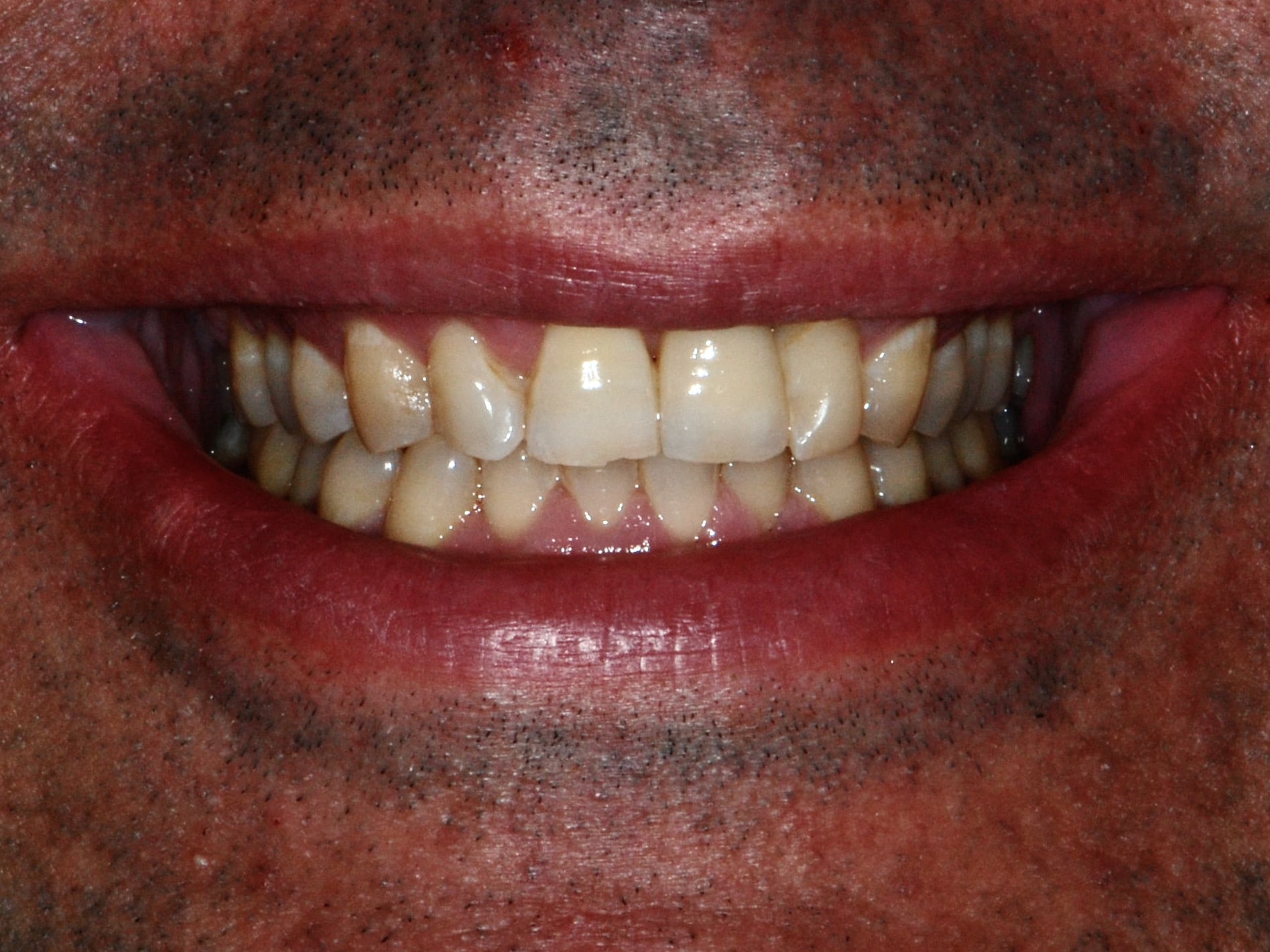Single implant, after treatment, front view of smile