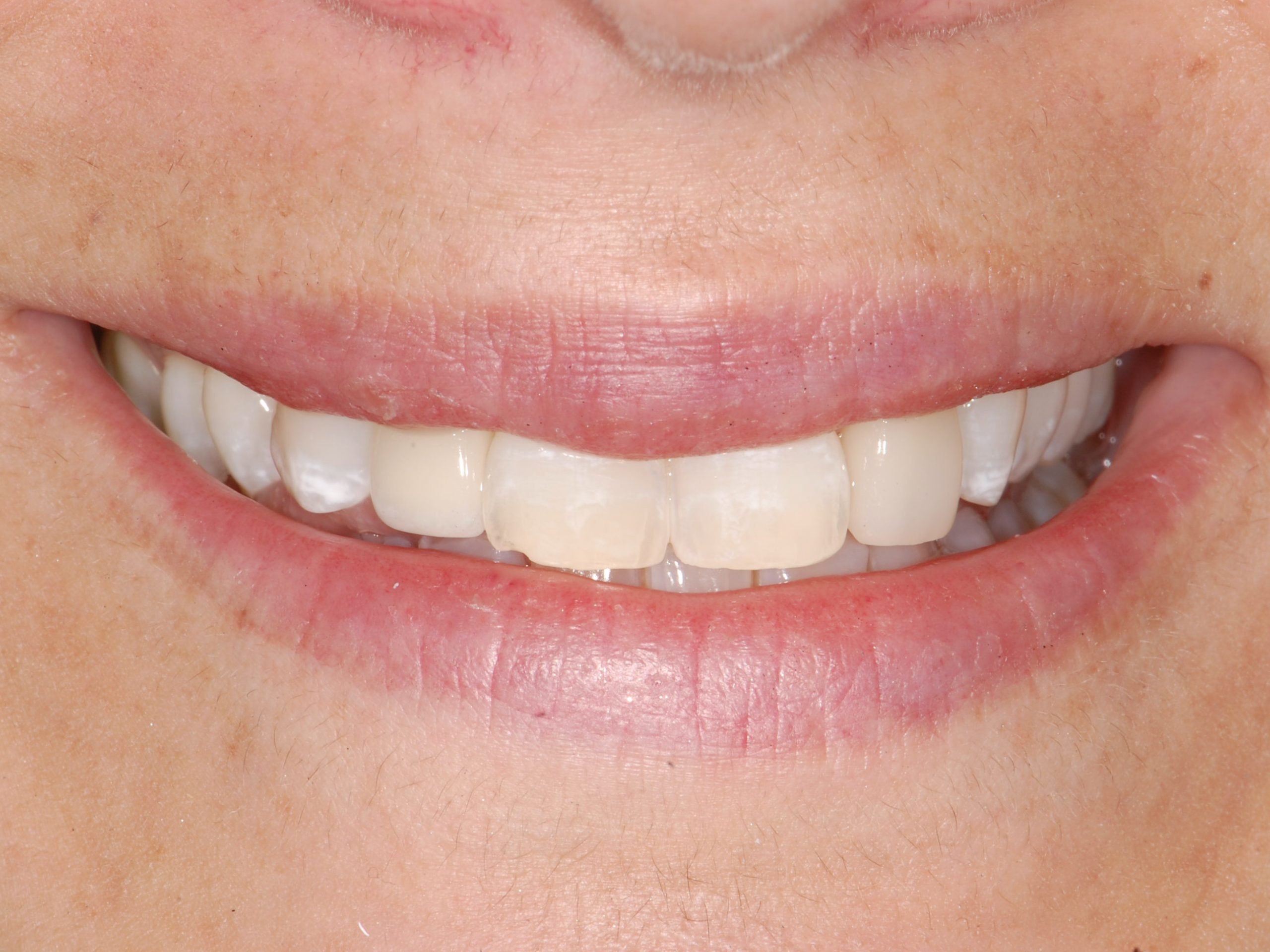 Single tooth replacement with an implant, after treatment, front view of smile