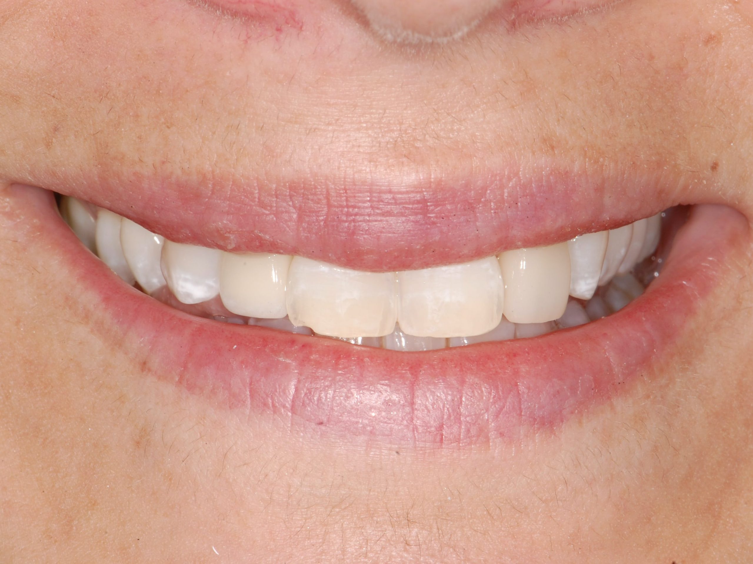 Single tooth replacement with an implant, after treatment, front view of smile