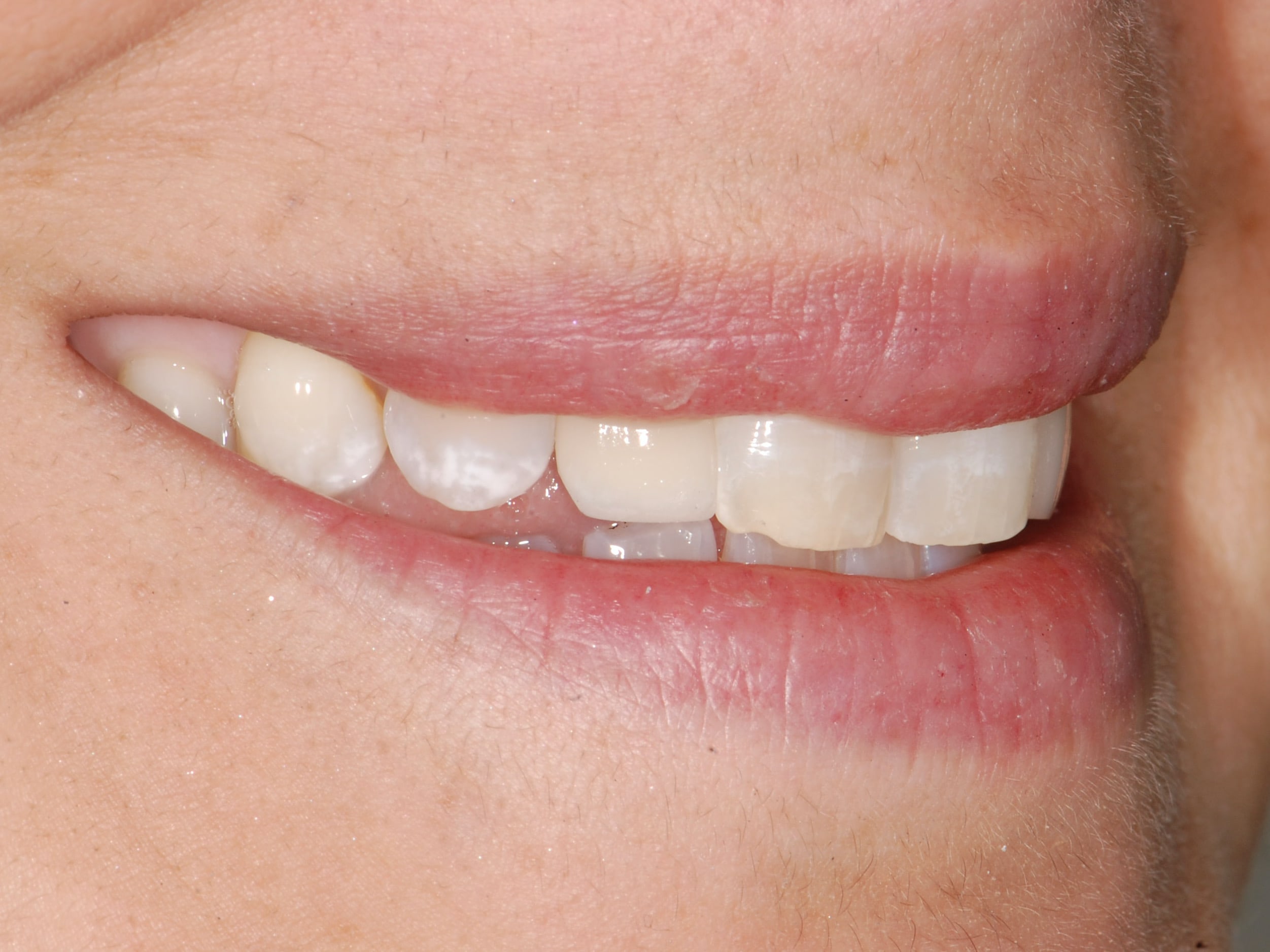Single tooth replacement with an implant, after treatment, left side view of smile