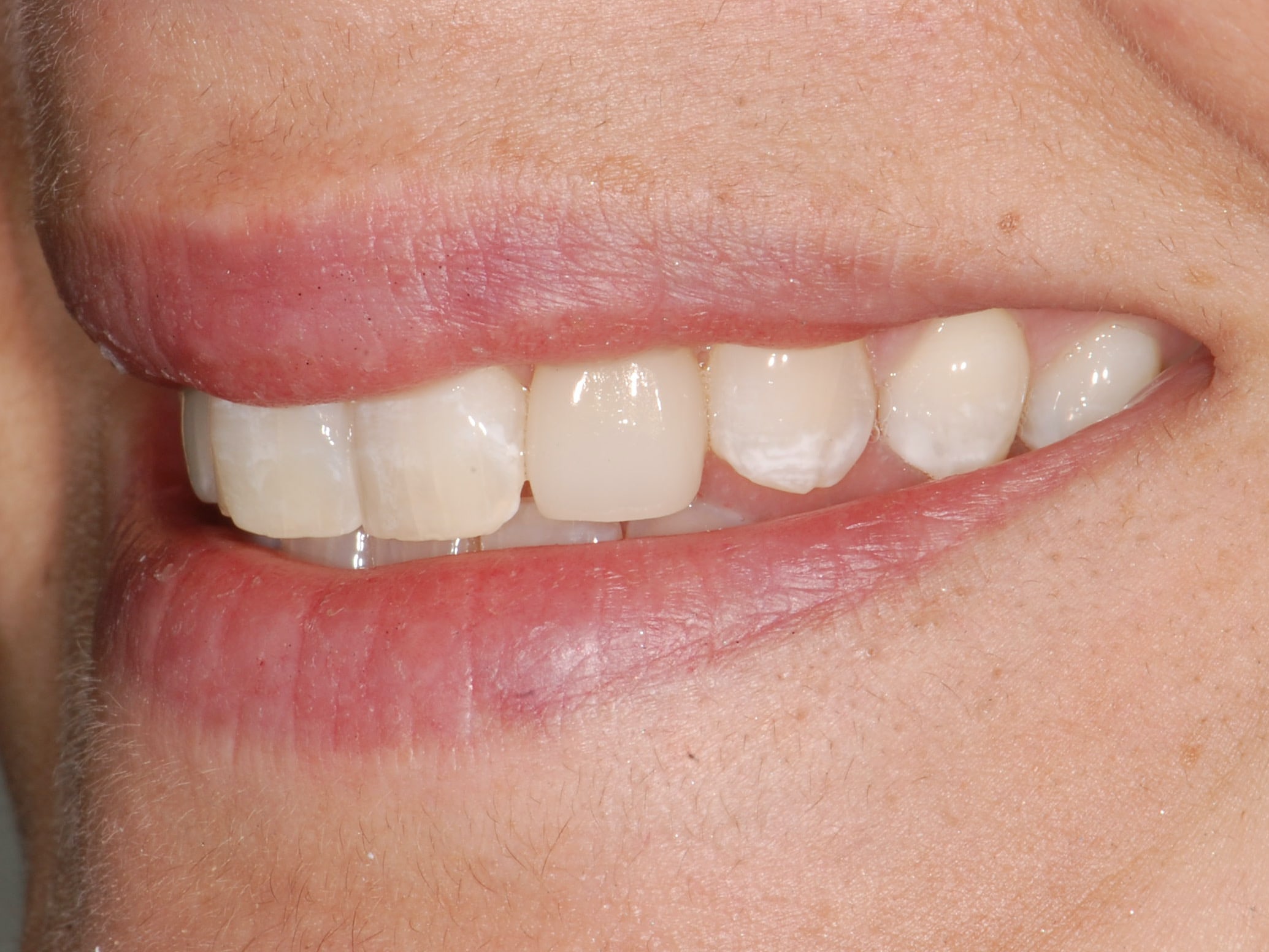 Single tooth replacement with an implant, after treatment, right side view of smile