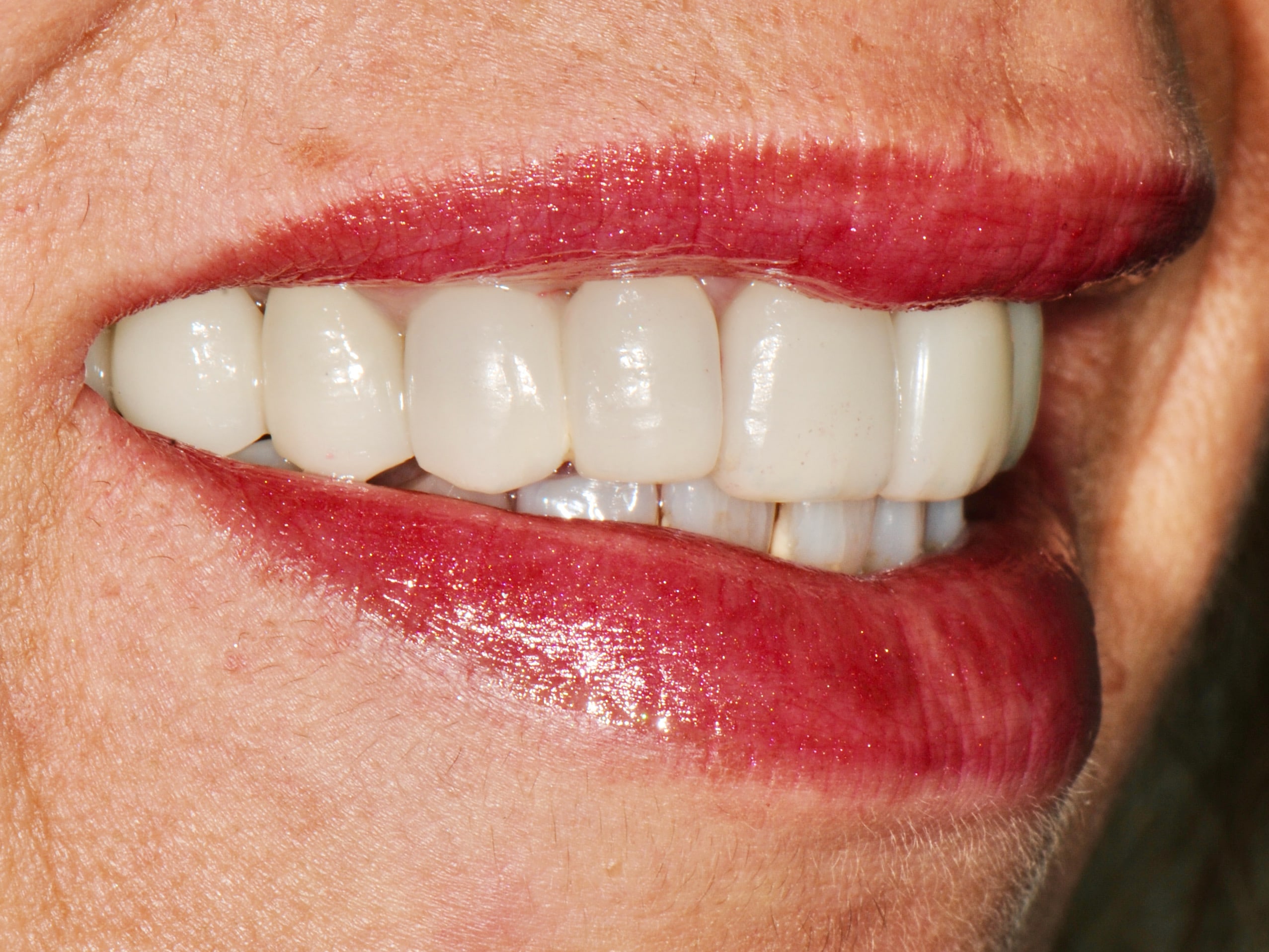 Multiple implant bridges, after treatment, left side view of smile