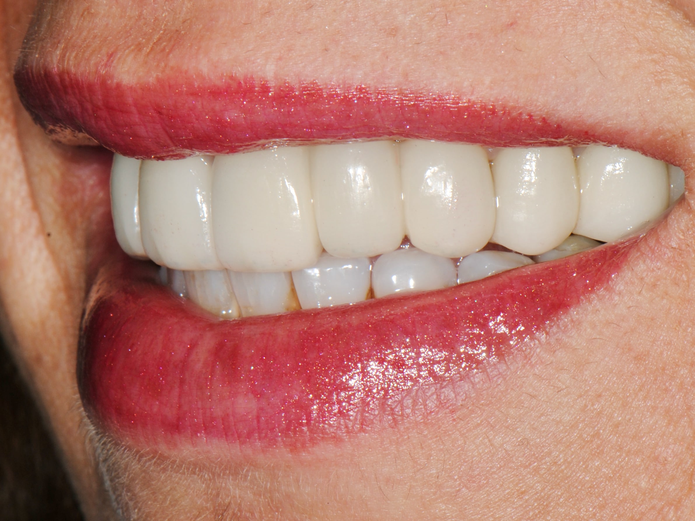 Multiple implant bridges, after treatment, right side view of smile