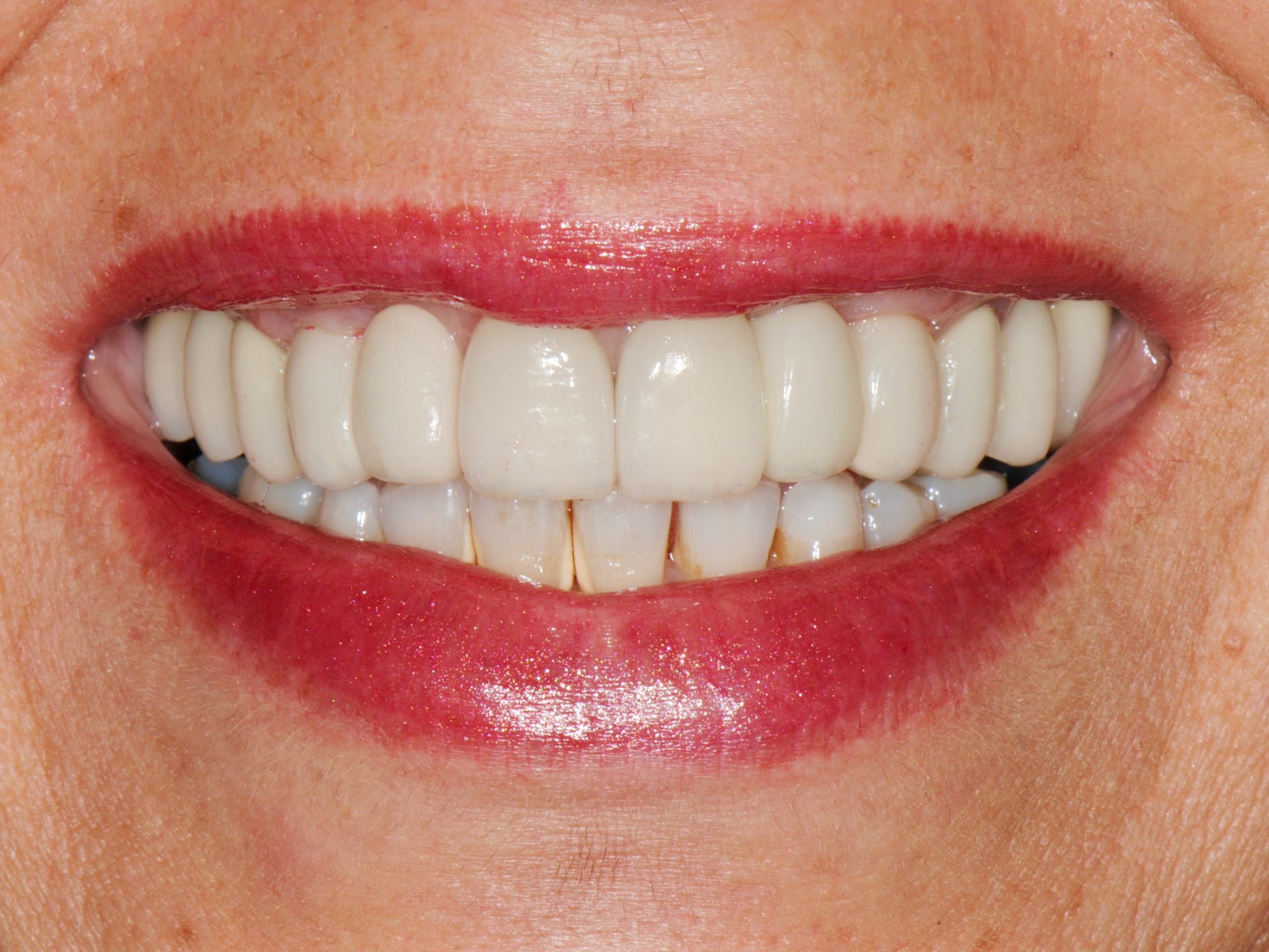 Multiple implant bridges, after treatment, front view of smile