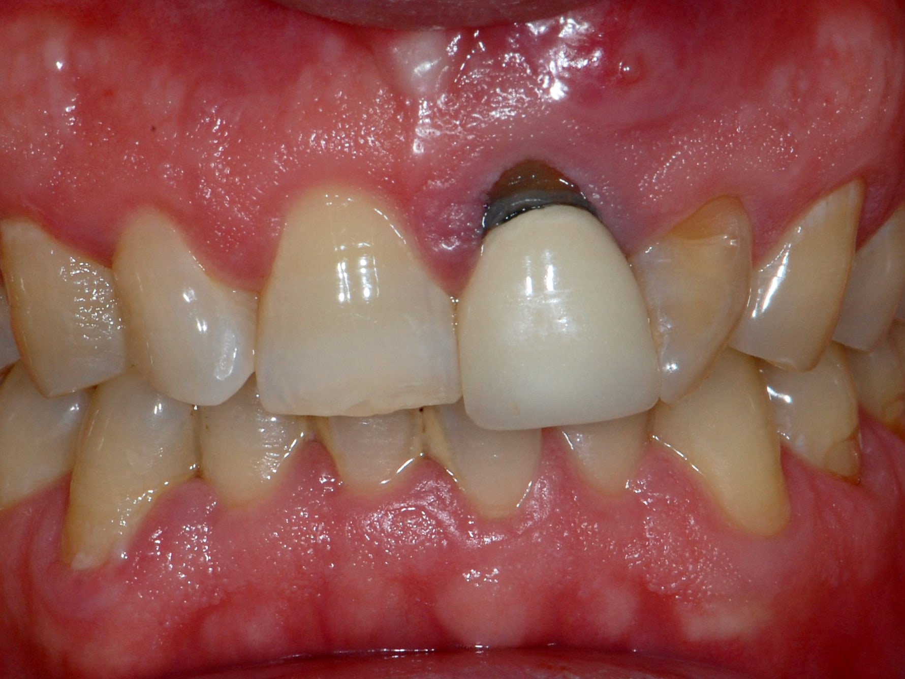Single implant, before treatment, close-up of teeth and gums