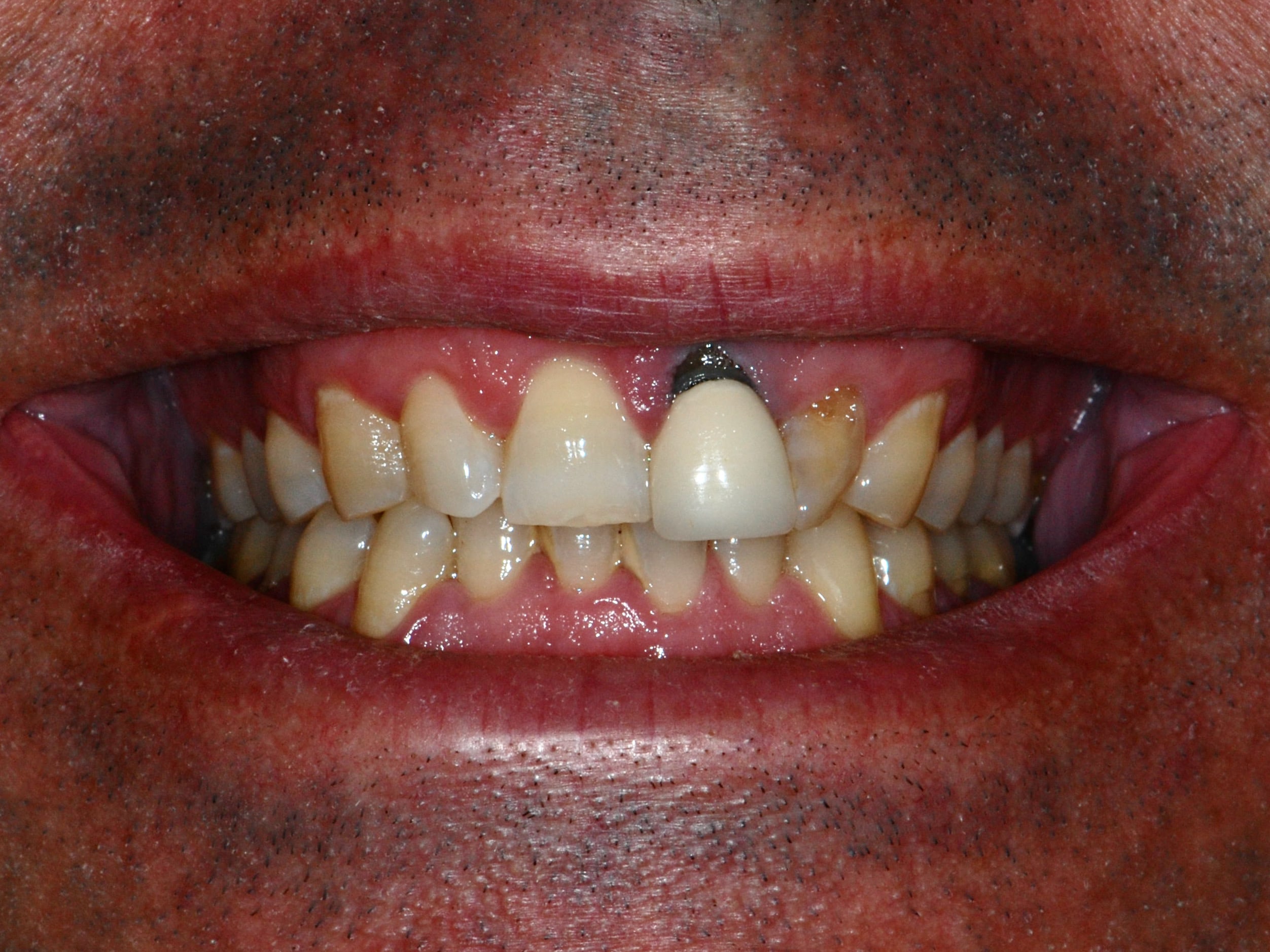 Single implant, before treatment, front view of smile