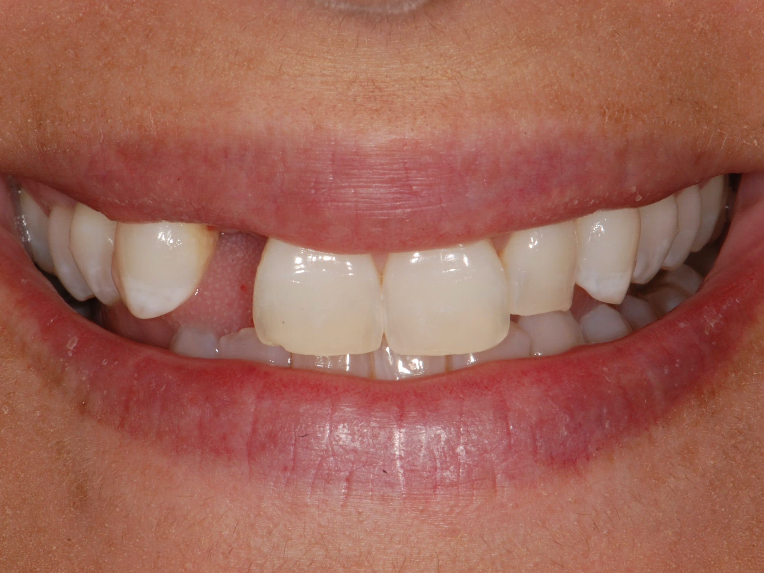 Single tooth replacement with an implant, before treatment, front view of smile