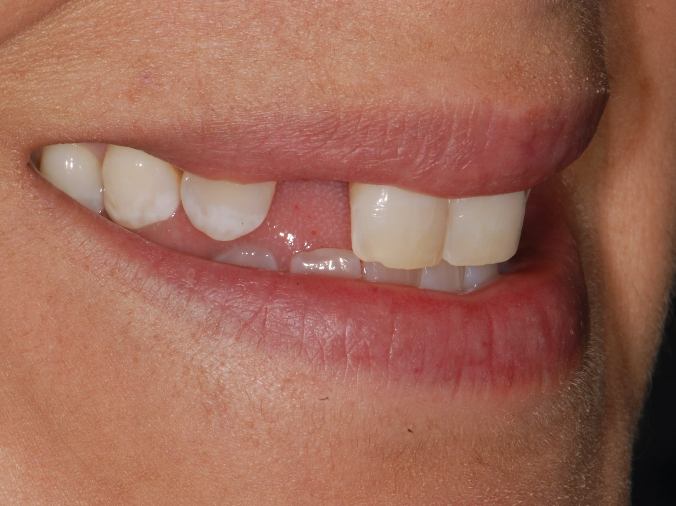 Single tooth replacement with an implant, before treatment, left side view of smile