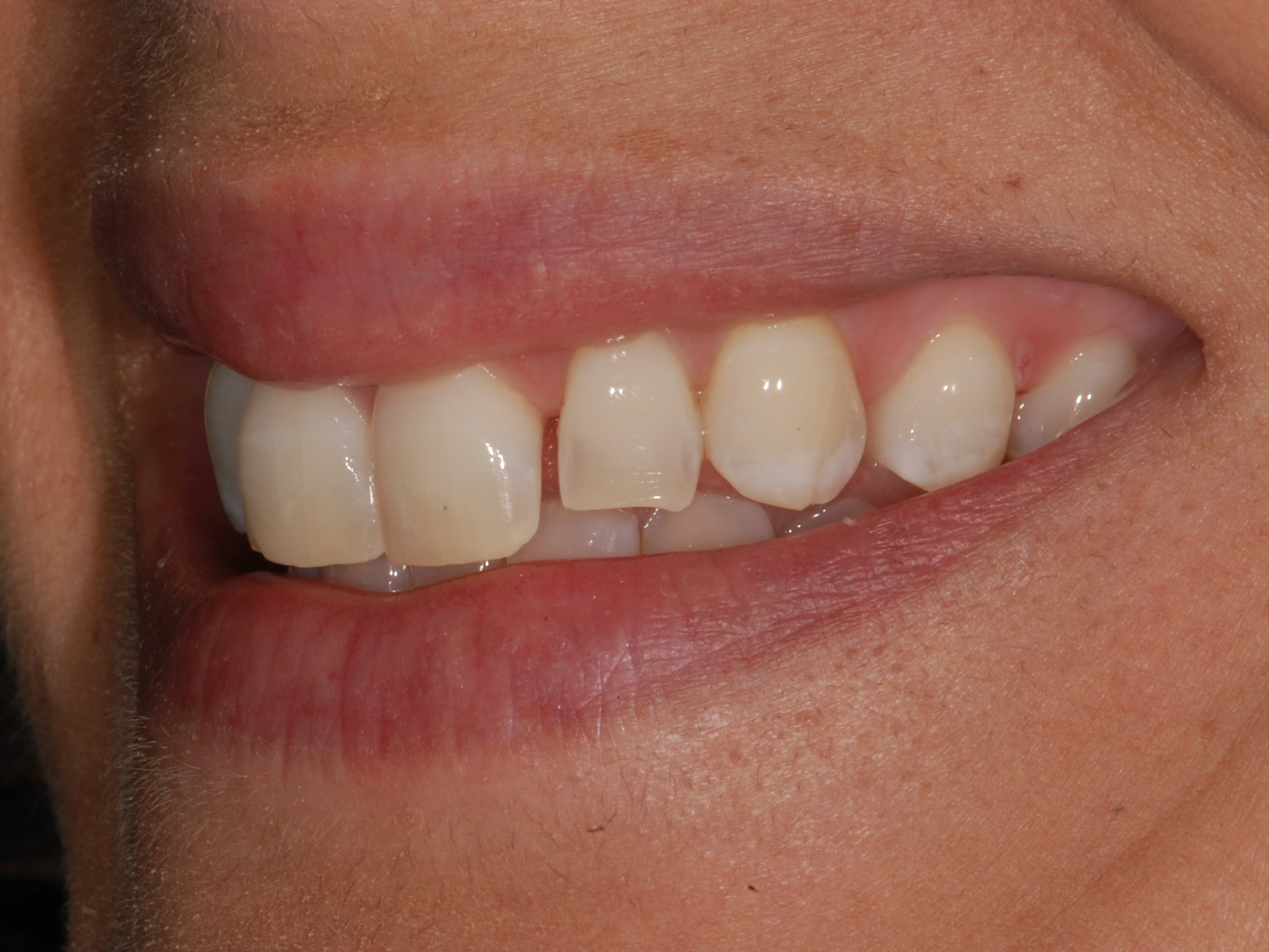 Single tooth replacement with an implant, before treatment, right side view of smile