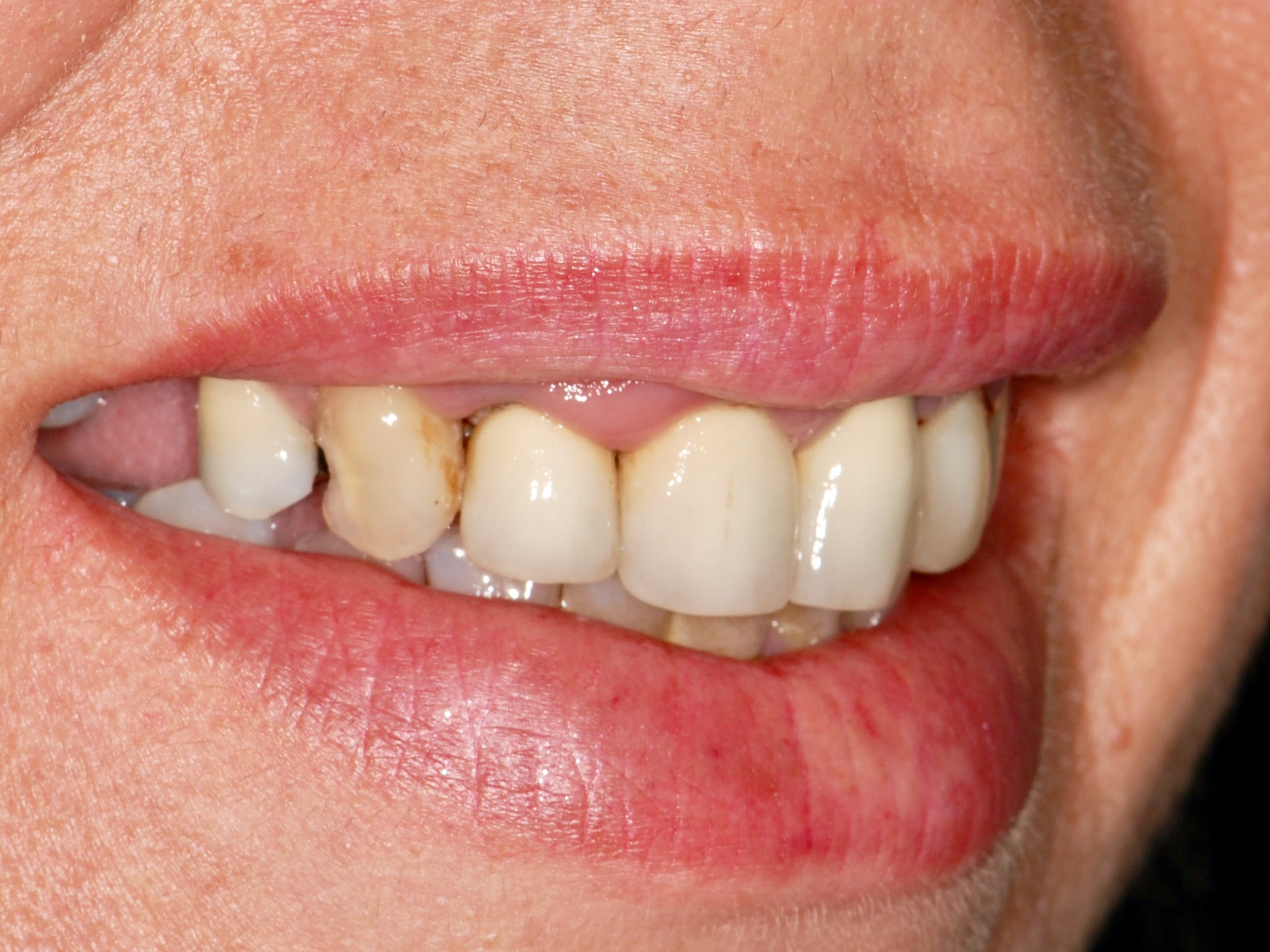 Multiple implant bridges, before treatment, left side view of smile
