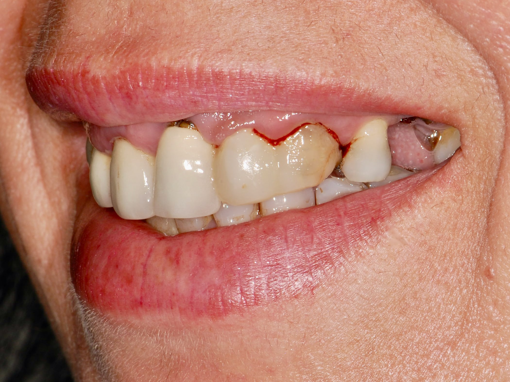 Multiple implant bridges, before treatment, right side view of smile