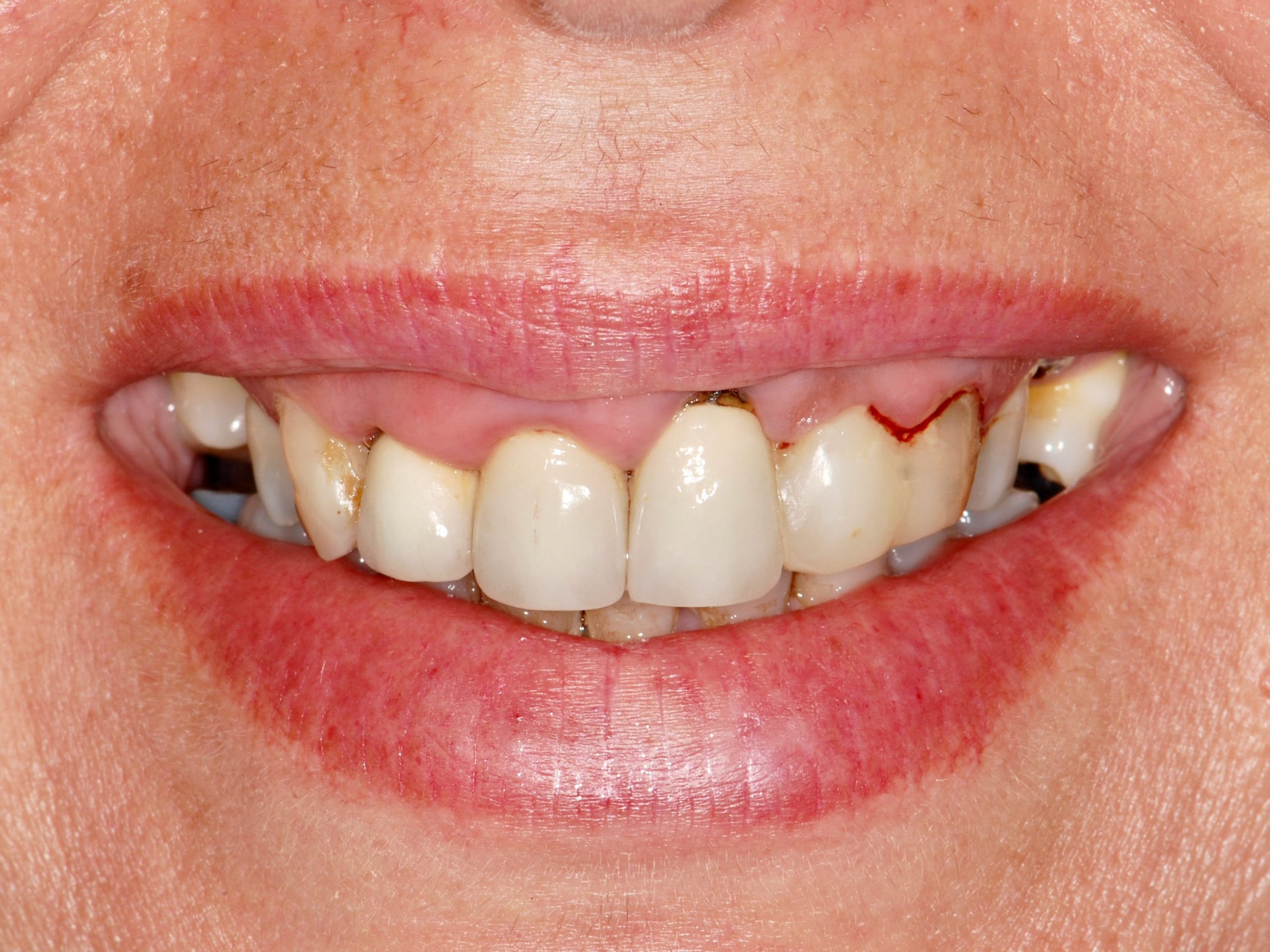 Multiple implant bridges, before treatment, front view of smile
