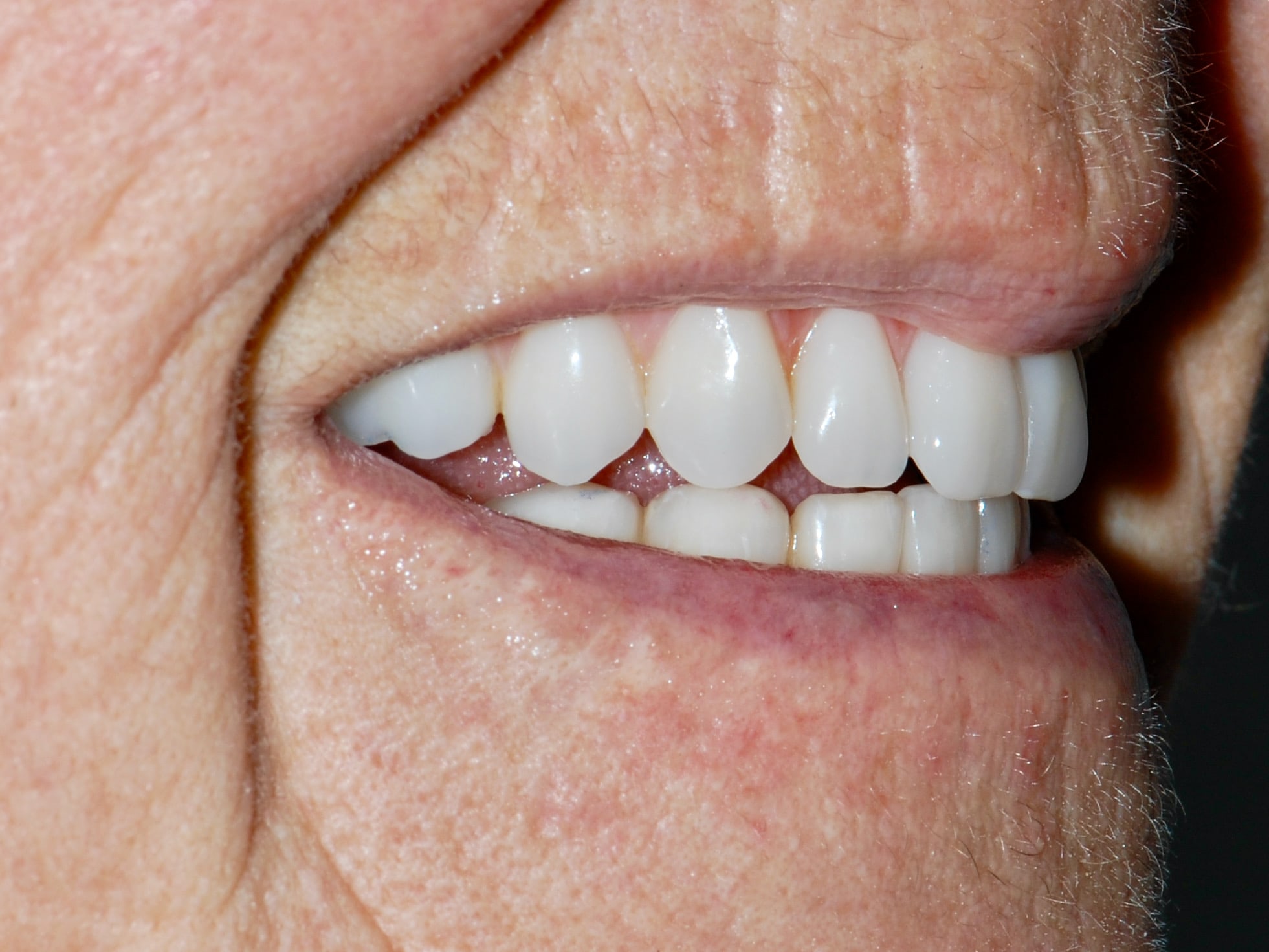 All-on-4 EverArch and lower porcelain veneers, after treatment, left side view of smile