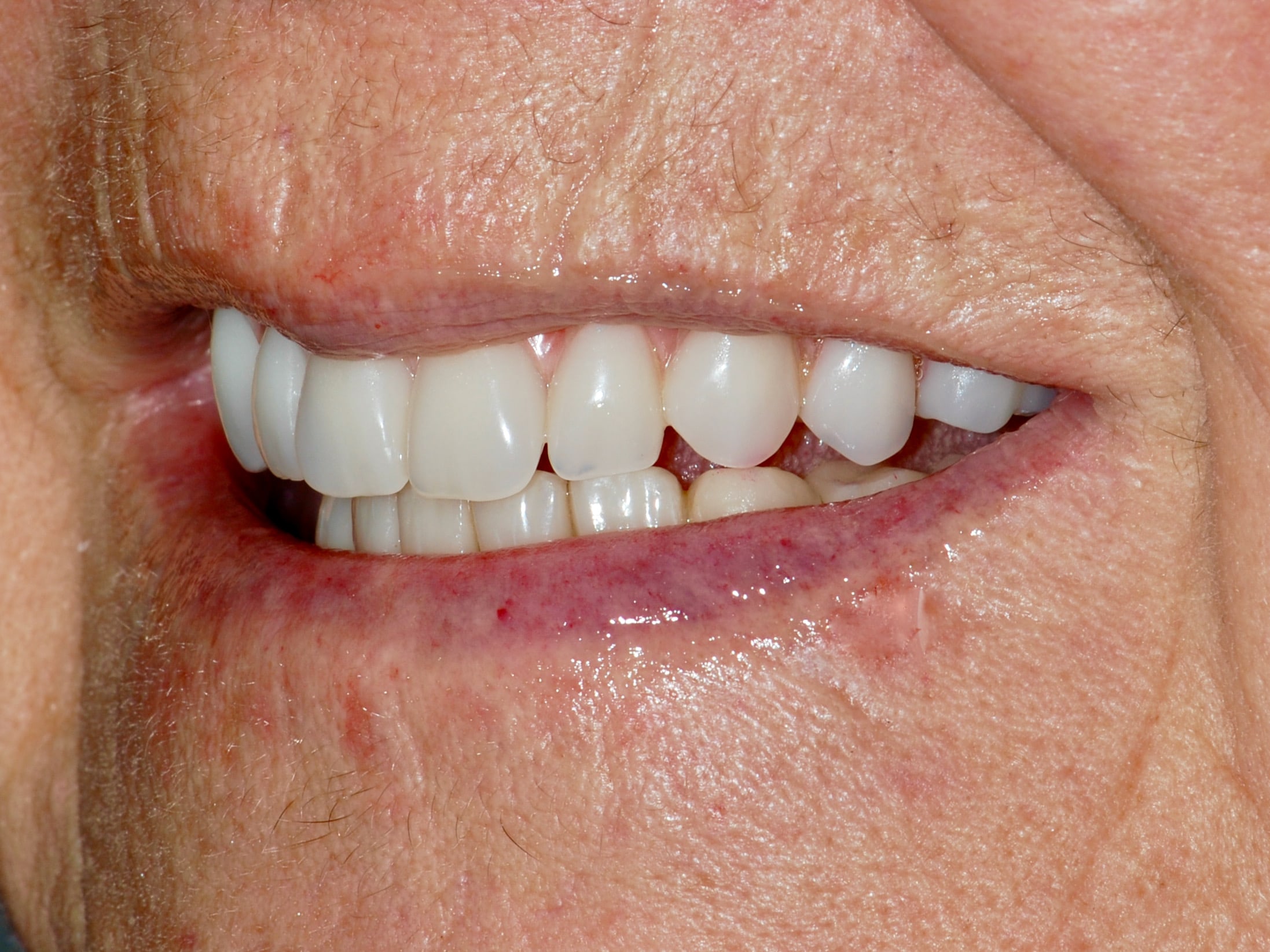 All-on-4 EverArch and lower porcelain veneers, after treatment, right side view of smile