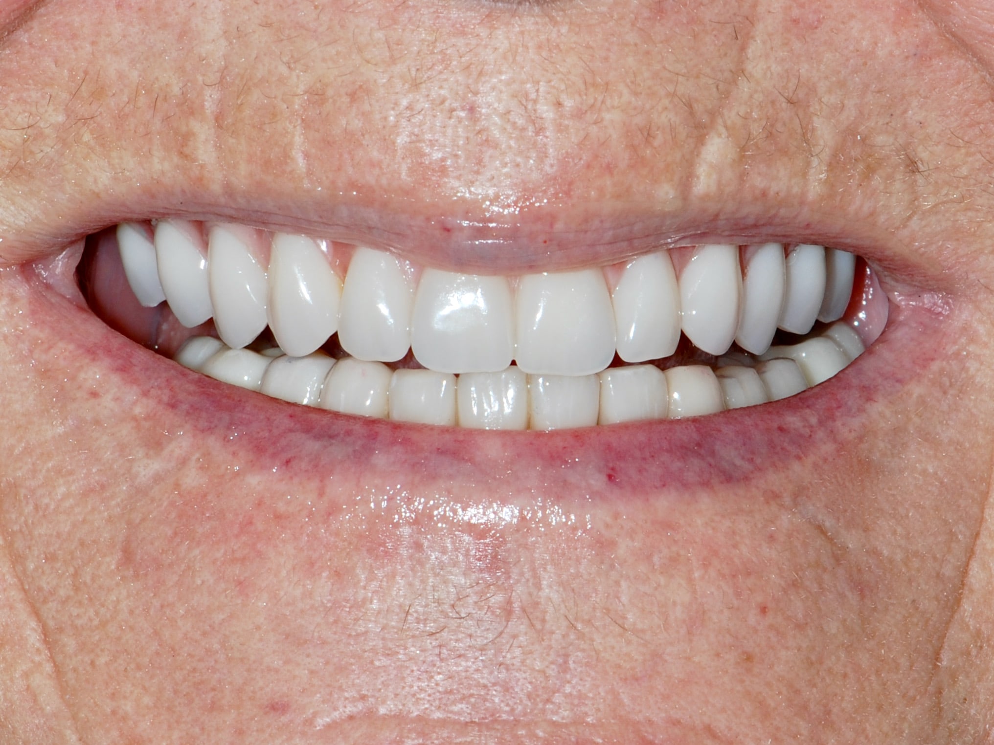 All-on-4 EverArch and lower porcelain veneers, after treatment, front view of smile