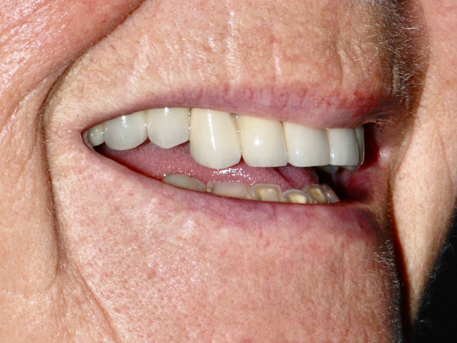 All-on-4 EverArch and lower porcelain veneers, before treatment, left side view of smile