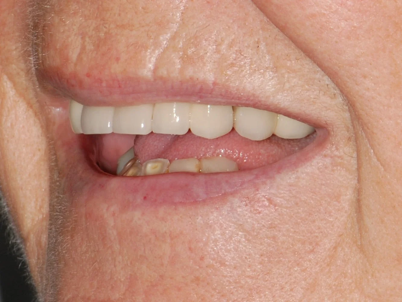 All-on-4 EverArch and lower porcelain veneers, before treatment, right side view of smile