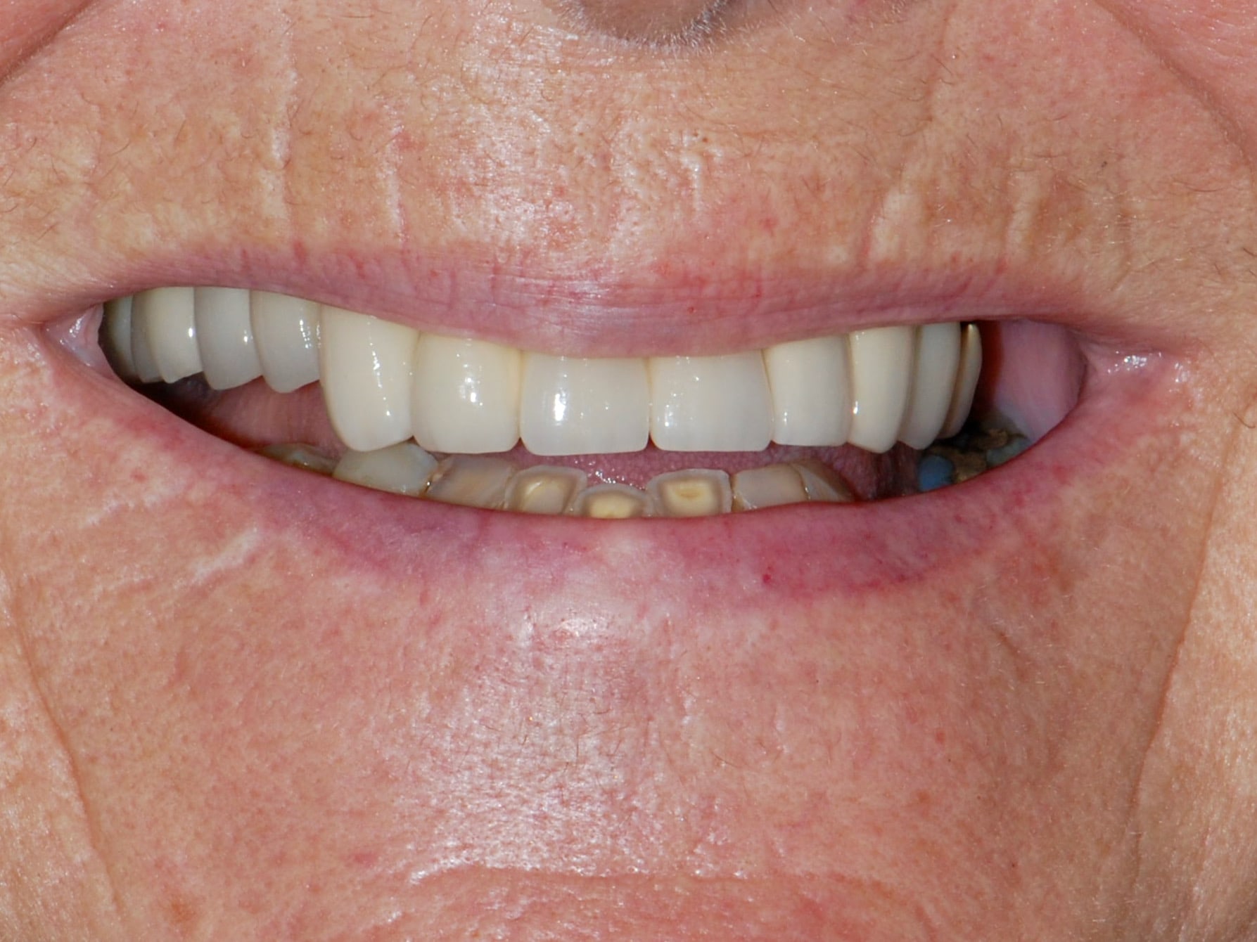 All-on-4 EverArch and lower porcelain veneers, before treatment, front view of smile