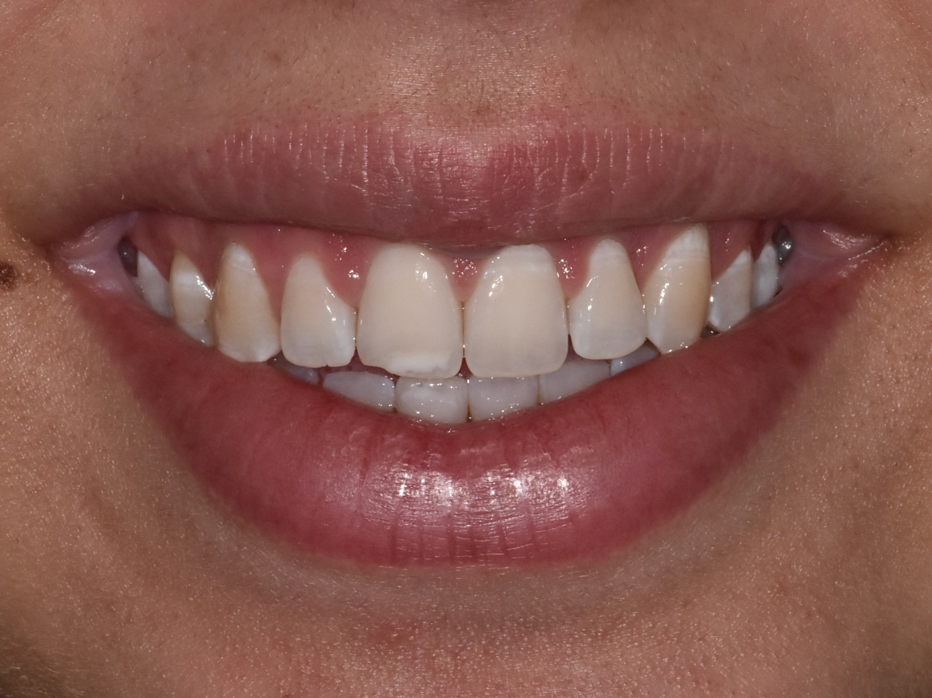 Gum contouring and composite bonding, after treatment, front view of smile