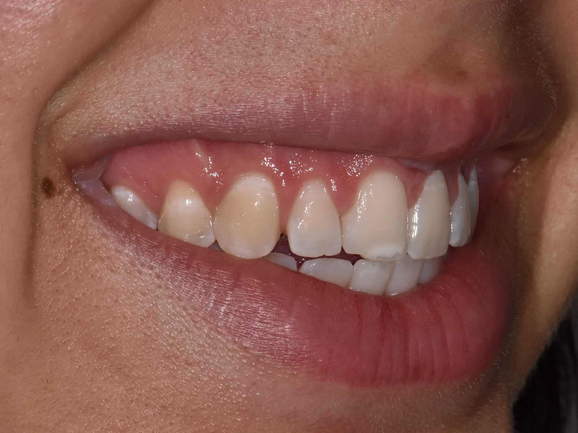 Gum contouring and composite bonding, after treatment, left side view of smile