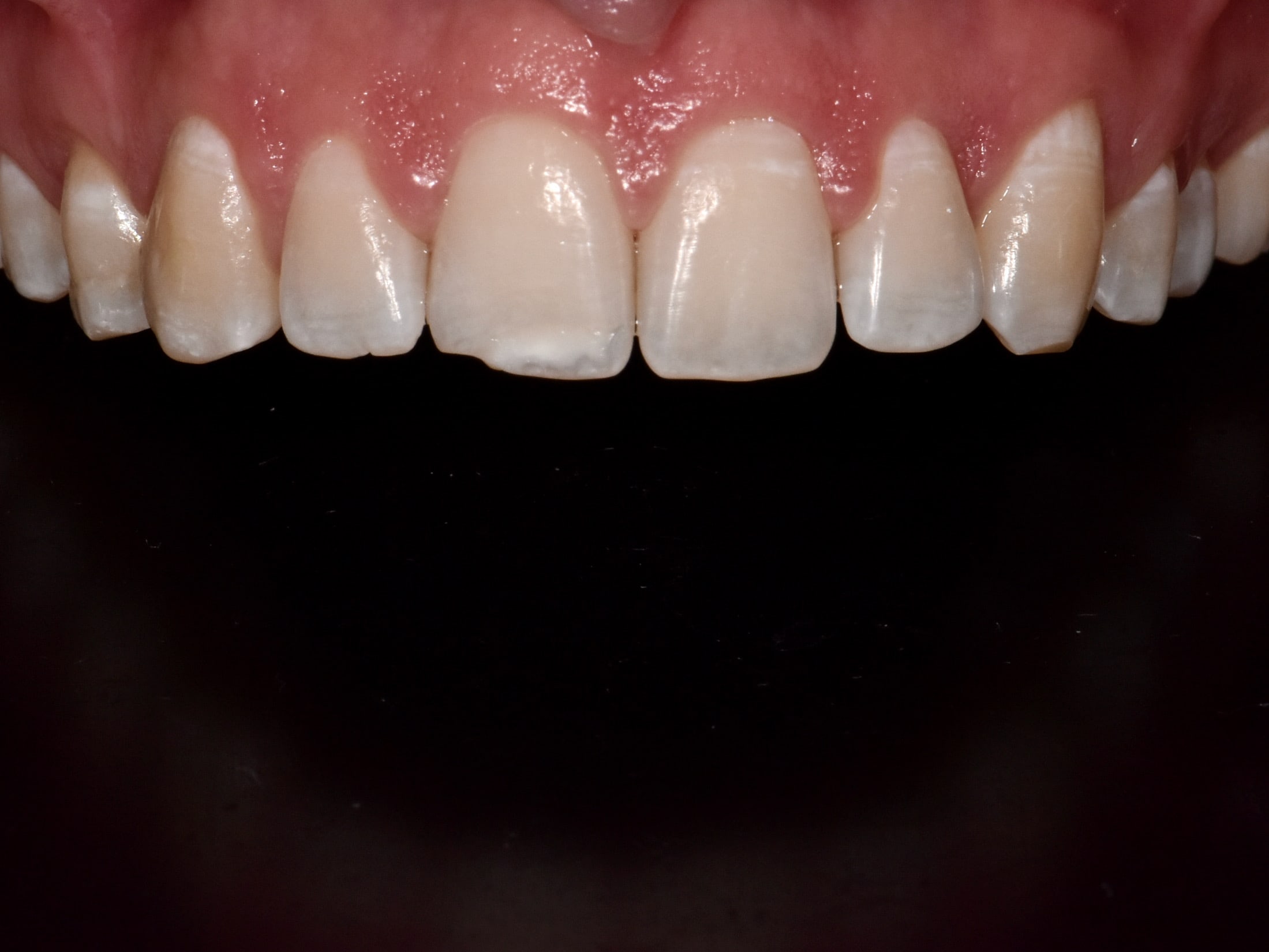 Gum contouring and composite bonding, after treatment, close-up of teeth and gums