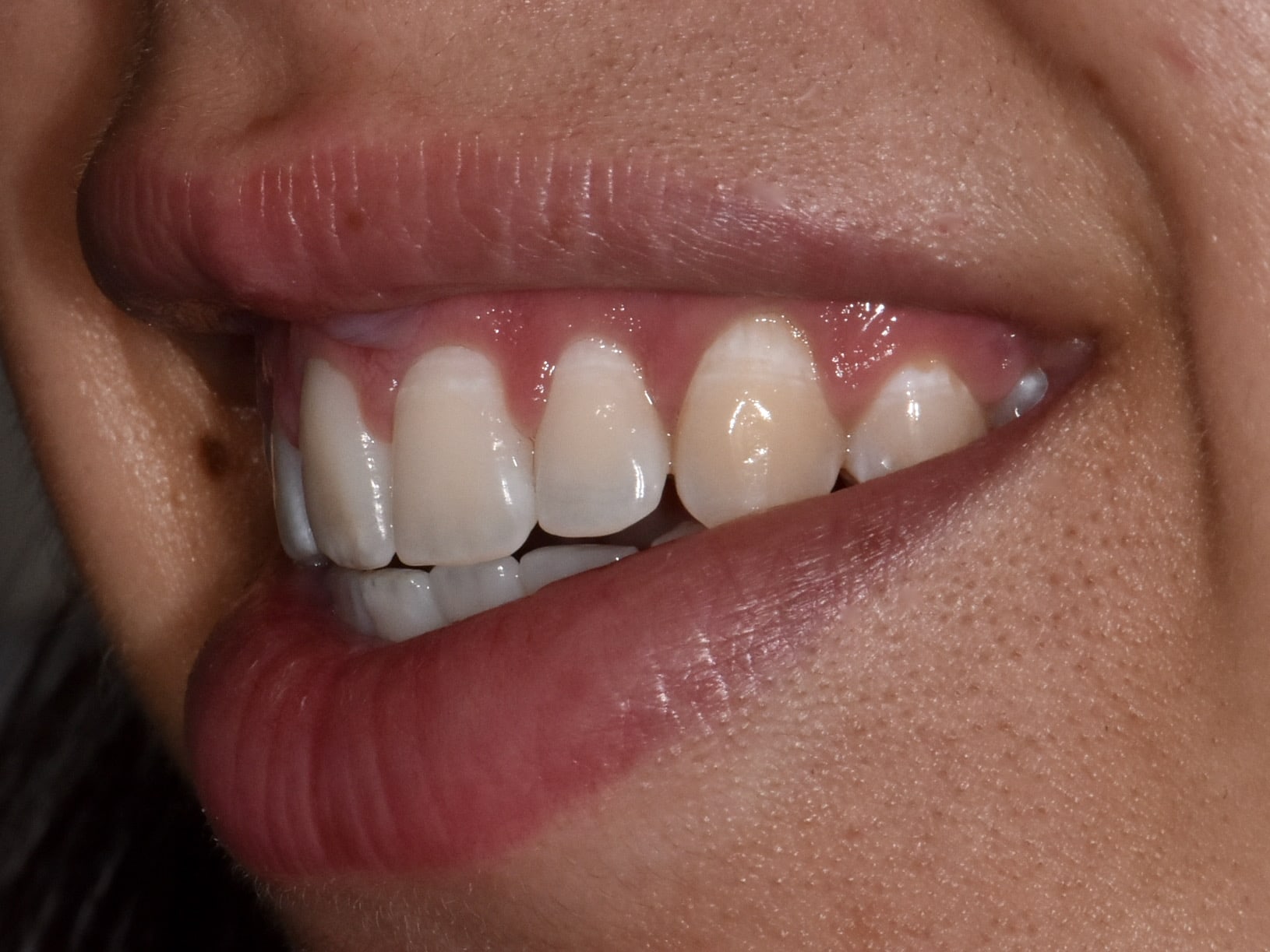 Gum contouring and composite bonding, after treatment, right side view of smile
