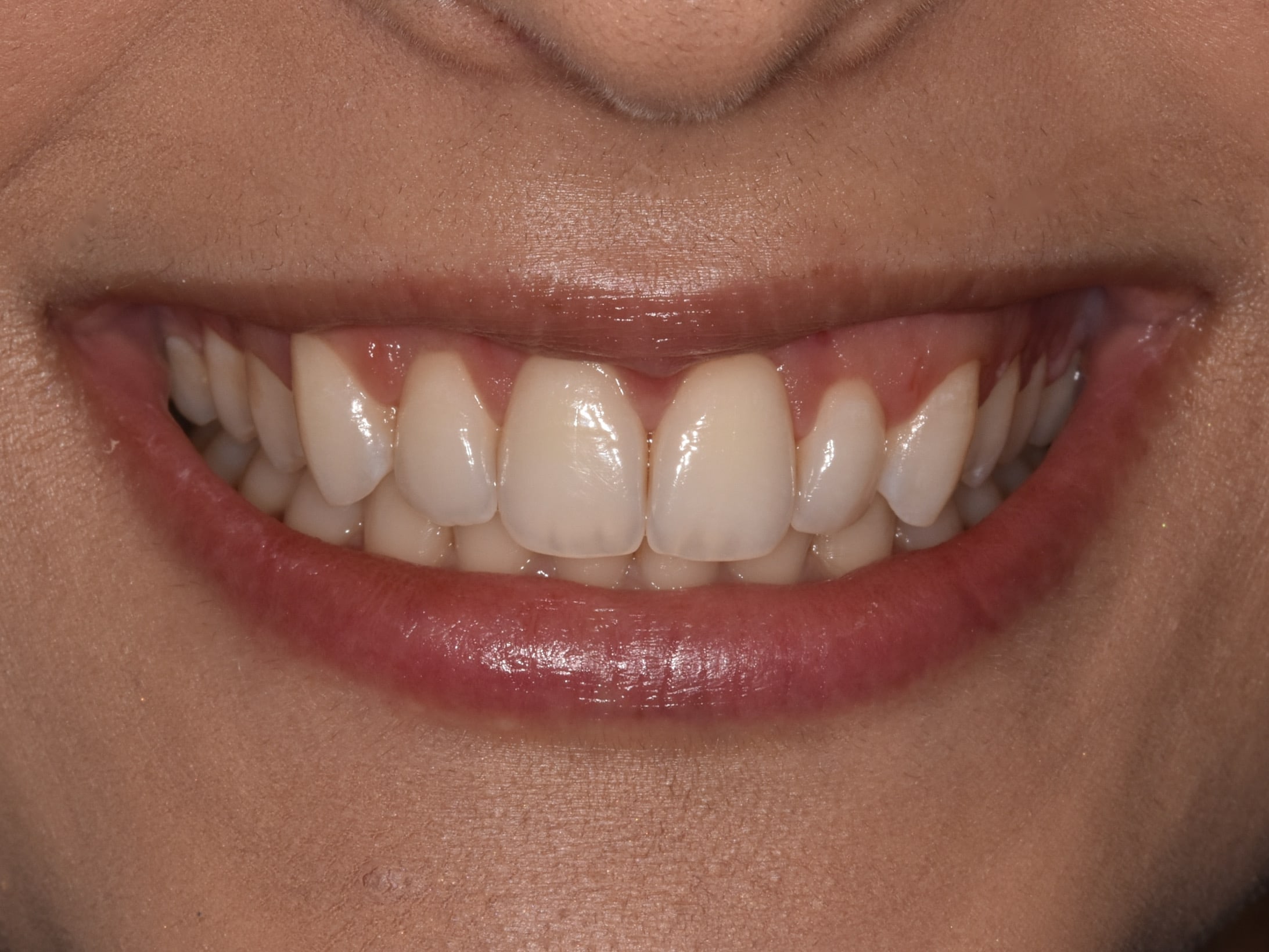 Gum contouring, after treatment, front view of smile