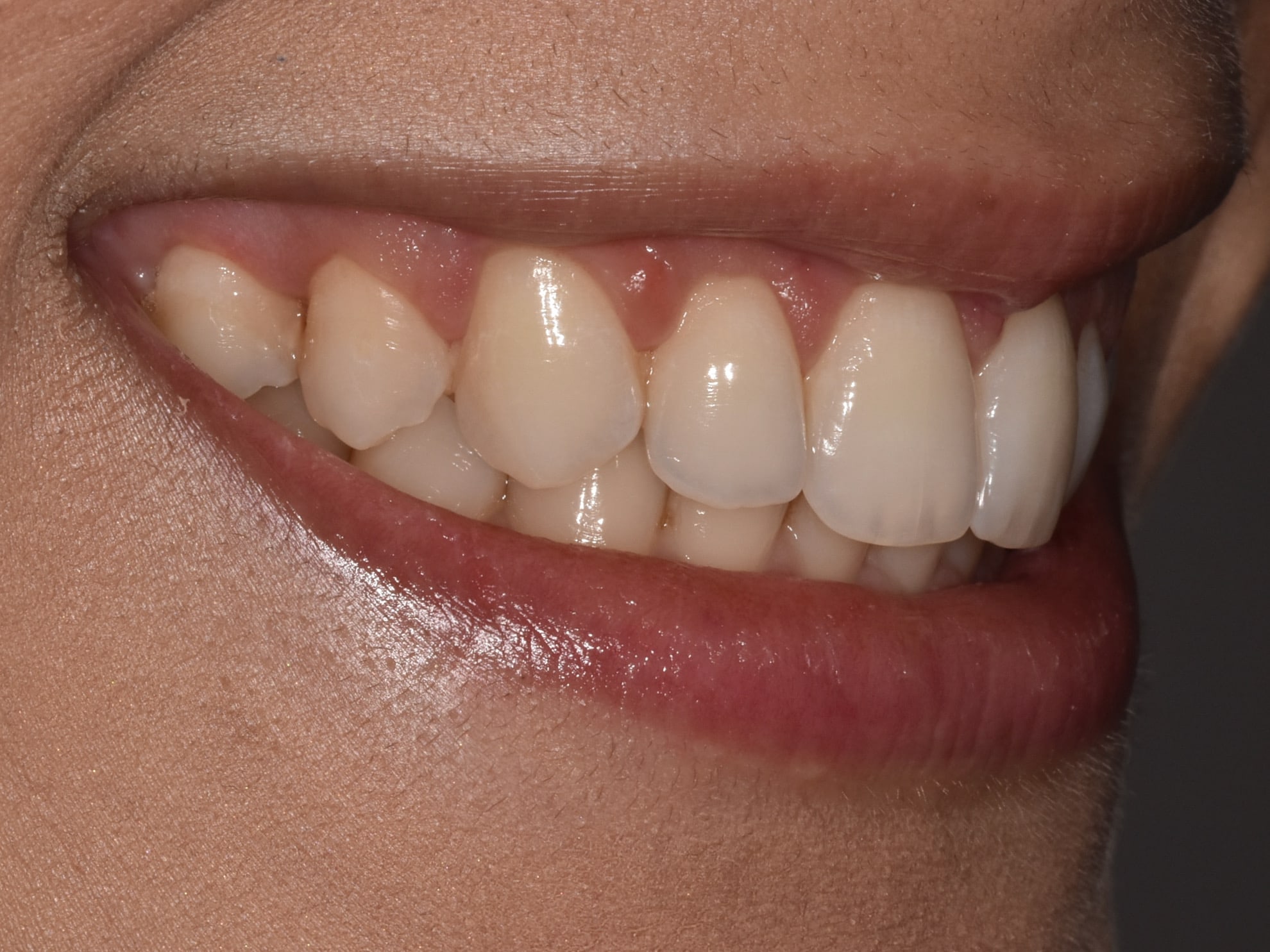Gum contouring, after treatment, left side view of smile