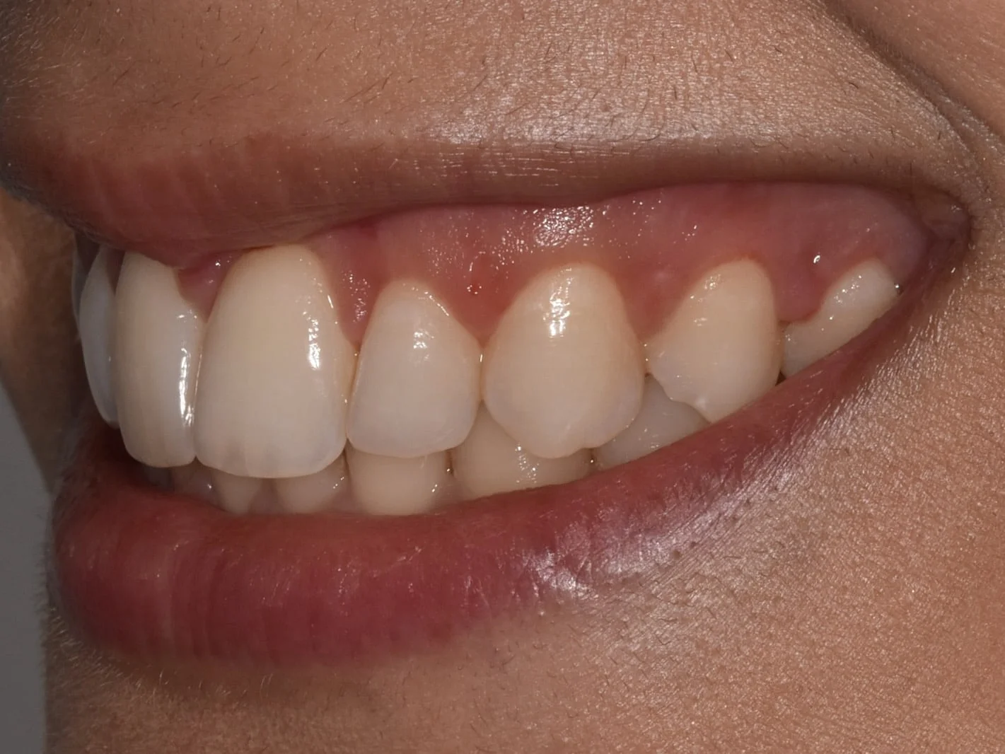 Gum contouring, after treatment, right side view of smile