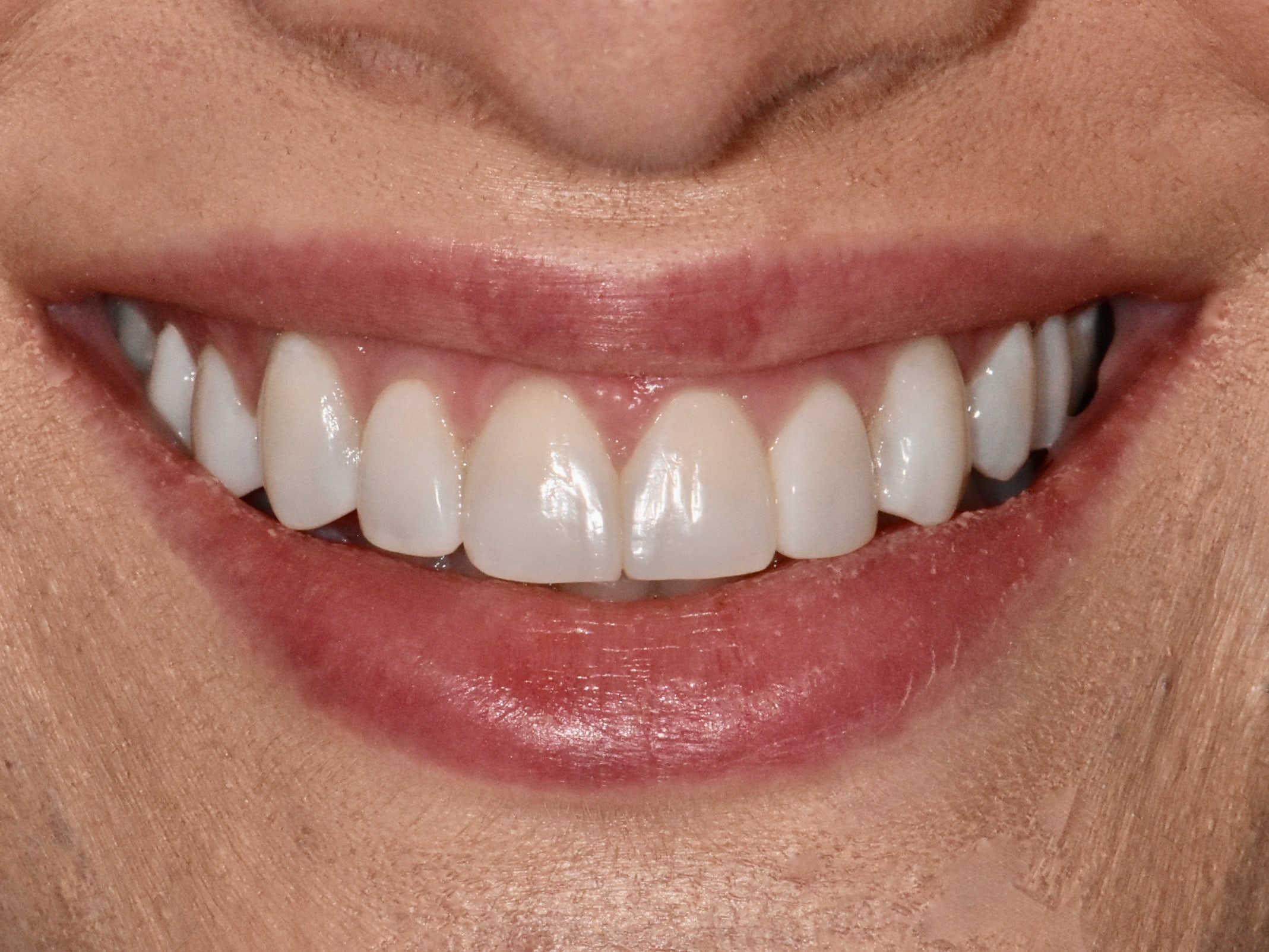 Gum contouring and composite bonding on 10 teeth, after treatment, front view of smile
