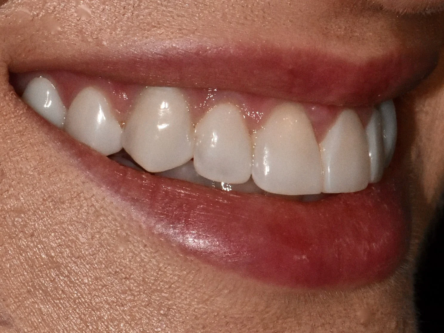 Gum contouring and composite bonding on 10 teeth, after treatment, left side view of smile