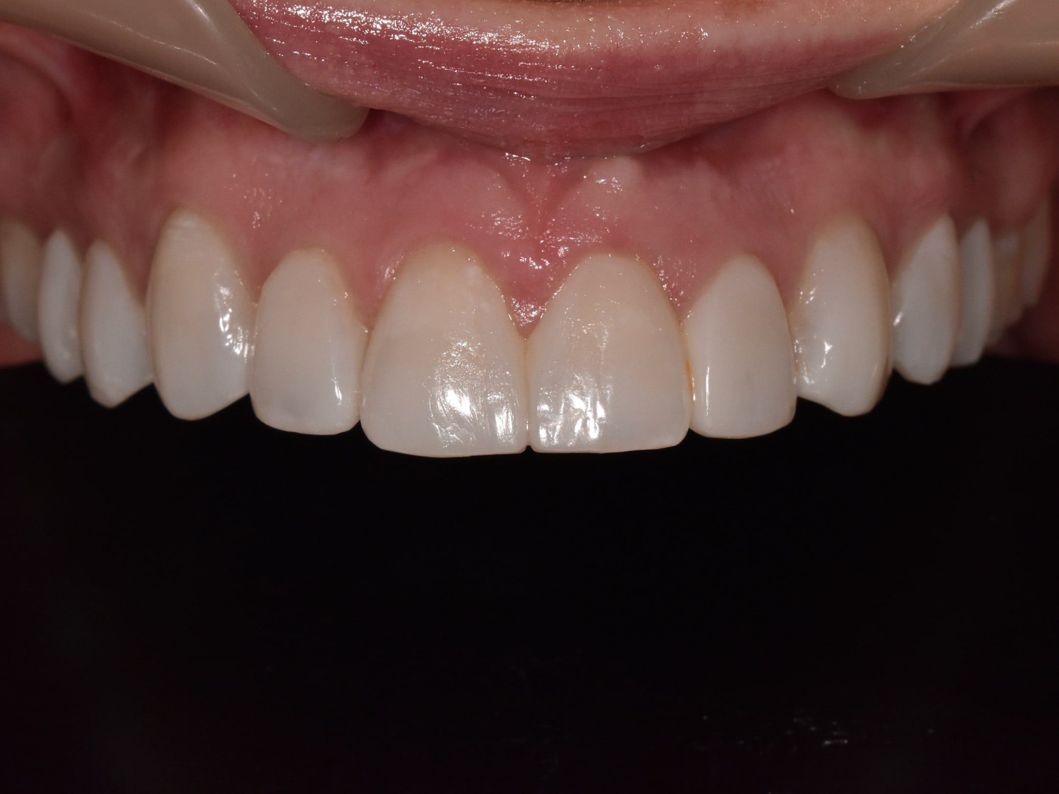 Gum contouring and composite bonding on 10 teeth, after treatment, close-up of teeth and gums