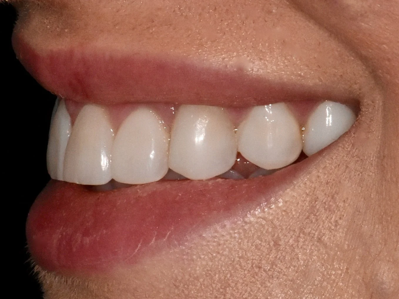 Gum contouring and composite bonding on 10 teeth, after treatment, right side view of smile
