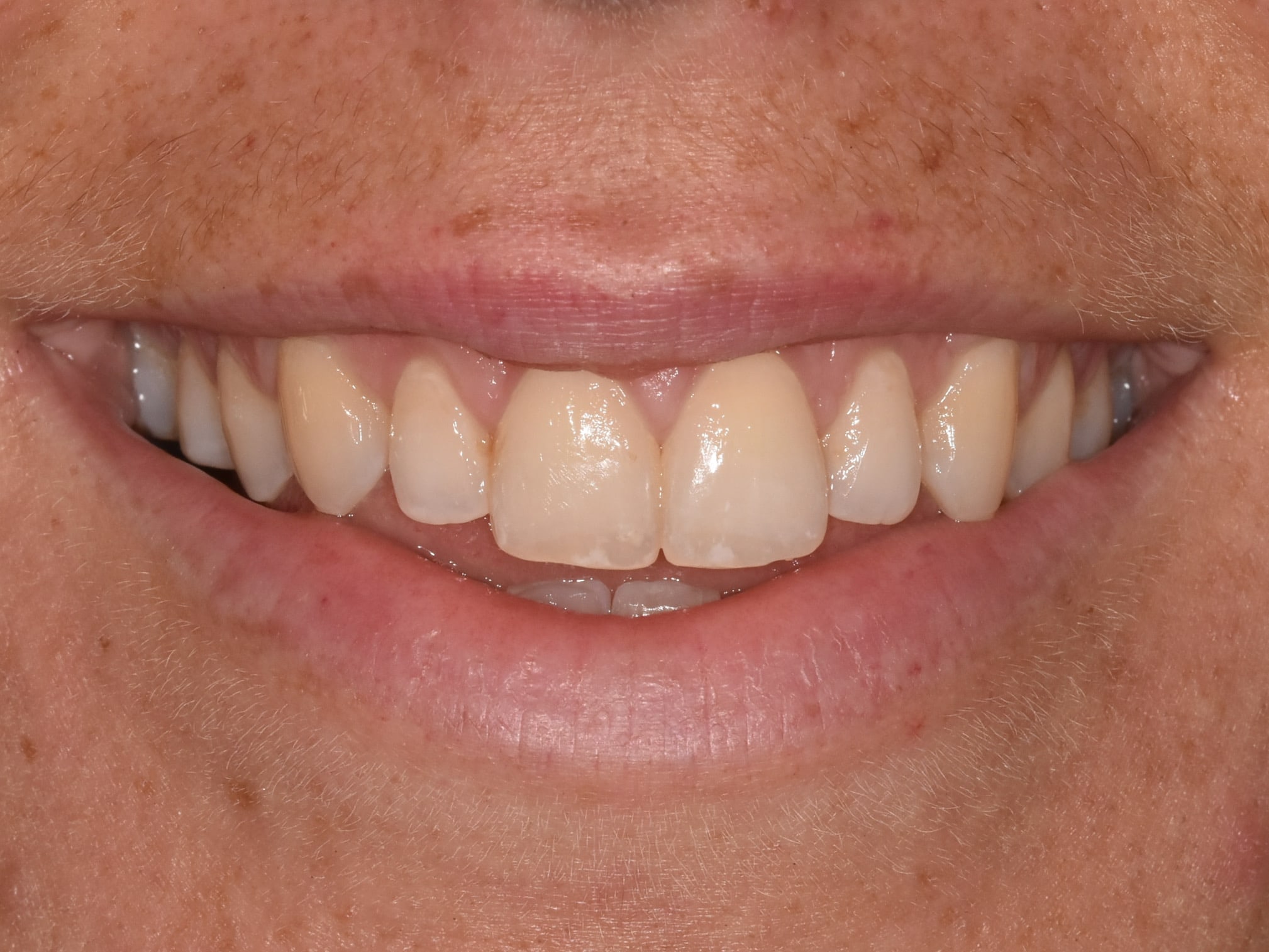 Gum contouring, after treatment, front view of smile