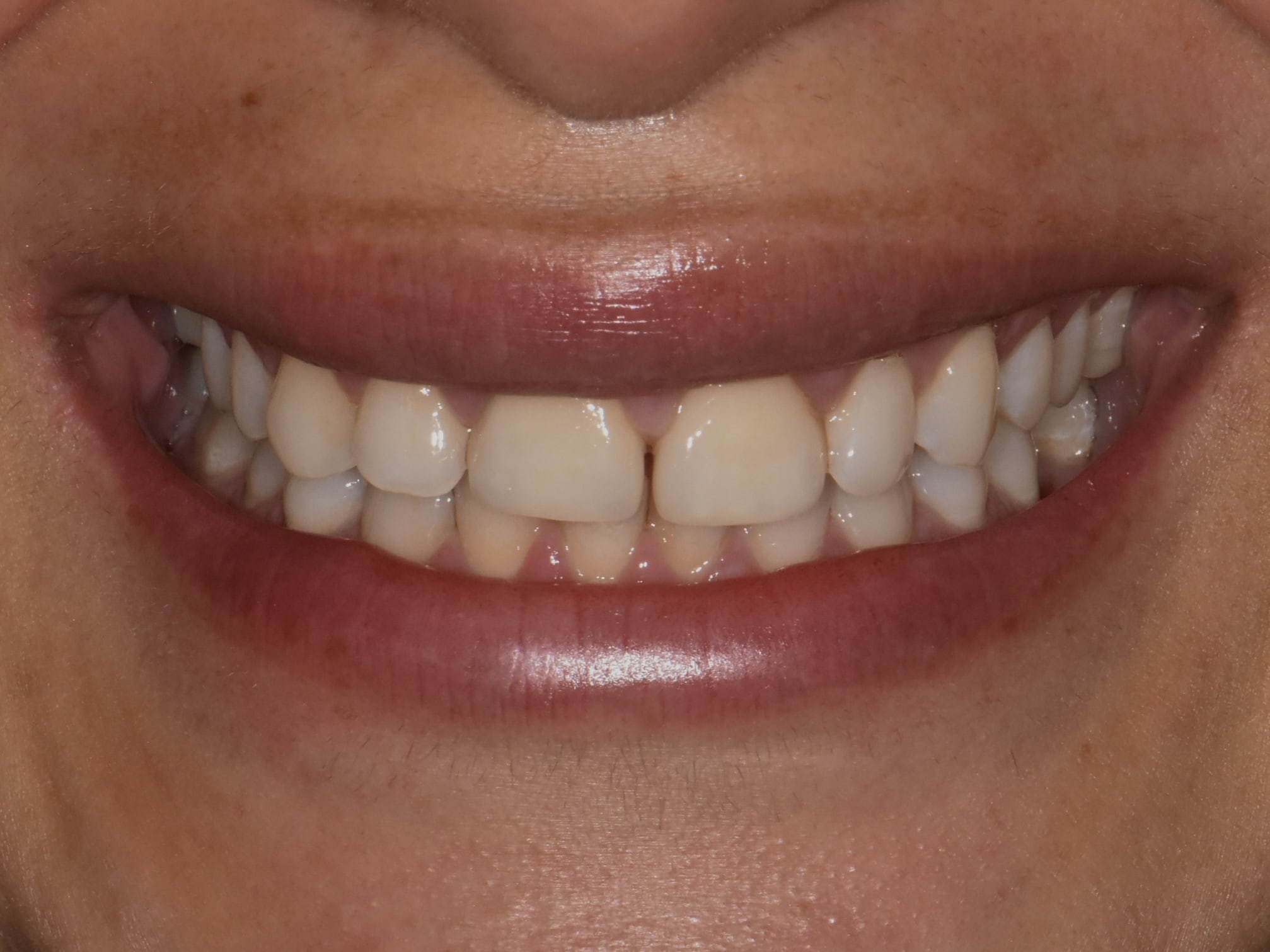 Gum contouring, 1 implant and 1 dental crown, after treatment, front view of smile