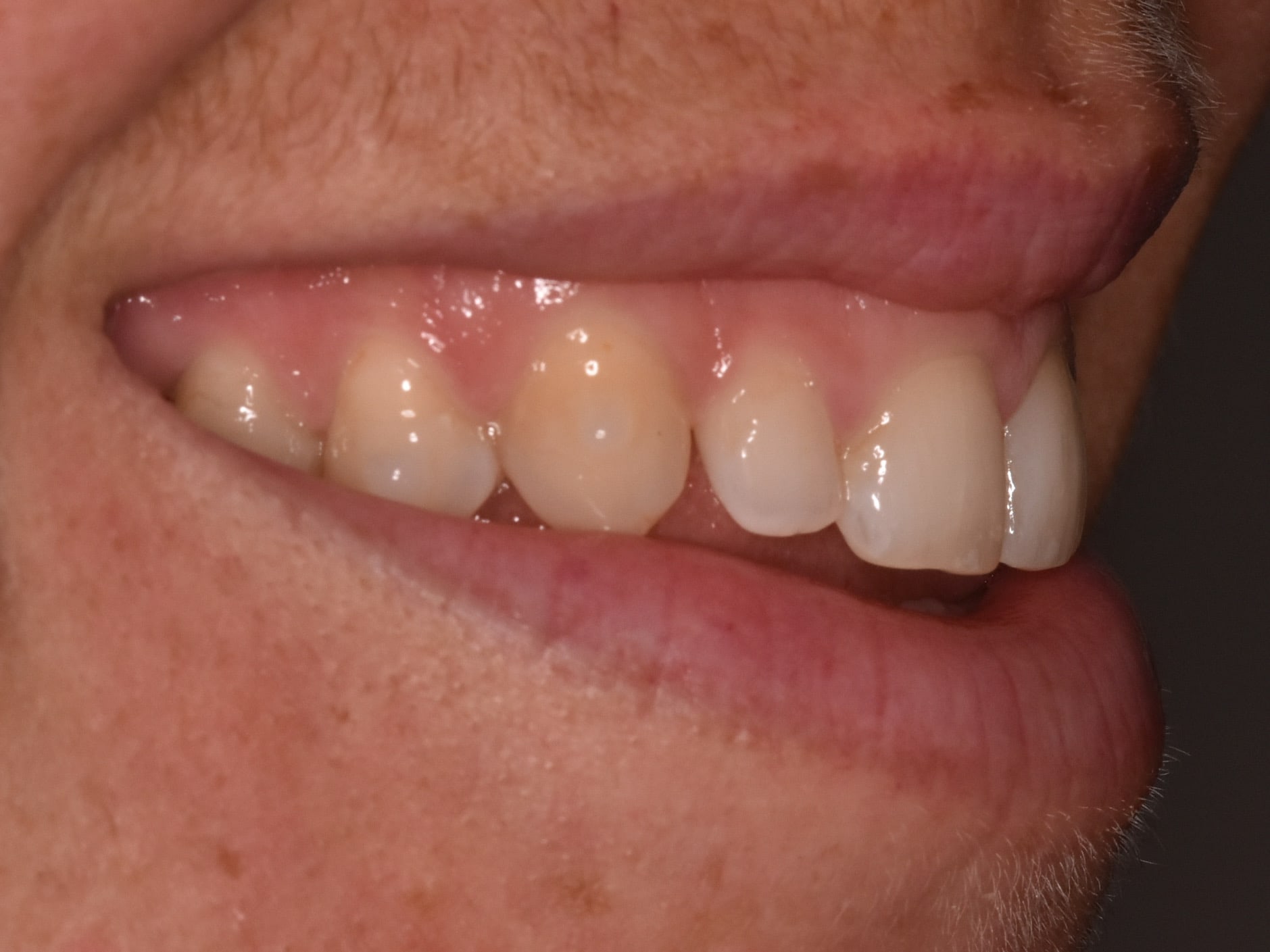 Gum contouring, after treatment, left side view of smile