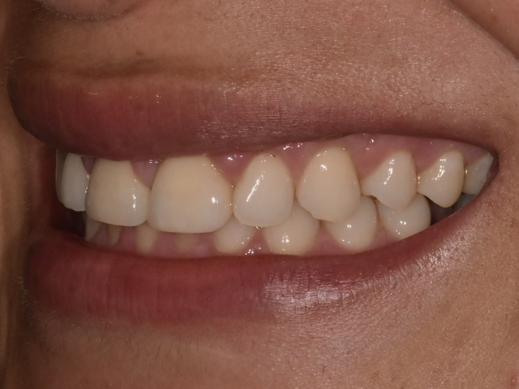 Gum contouring, 1 implant and 1 dental crown, after treatment, left side view of smile