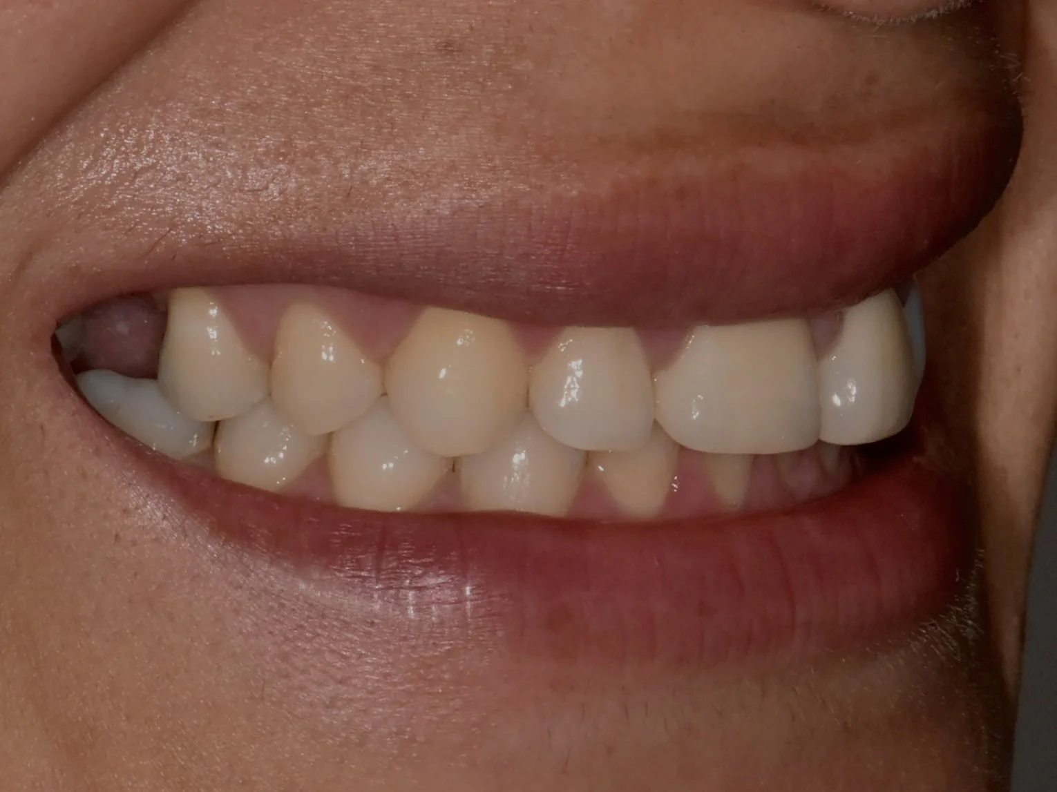 Gum contouring, 1 implant and 1 dental crown, after treatment, right side view of smile